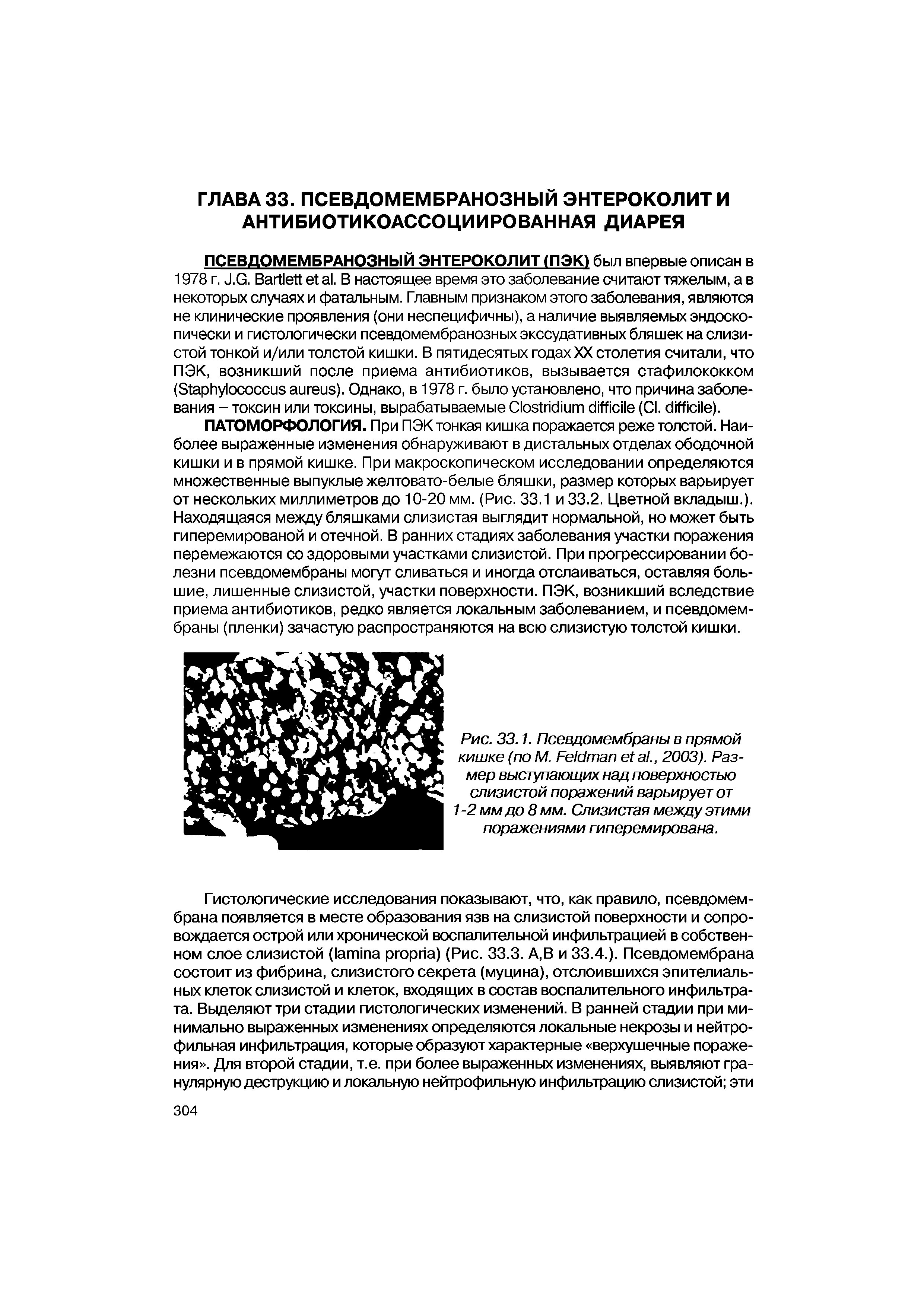 Рис. 33.1. Псевдомембраны в прямой кишке (по М. F ., 2003). Размер выступающих над поверхностью слизистой поражений варьирует от...