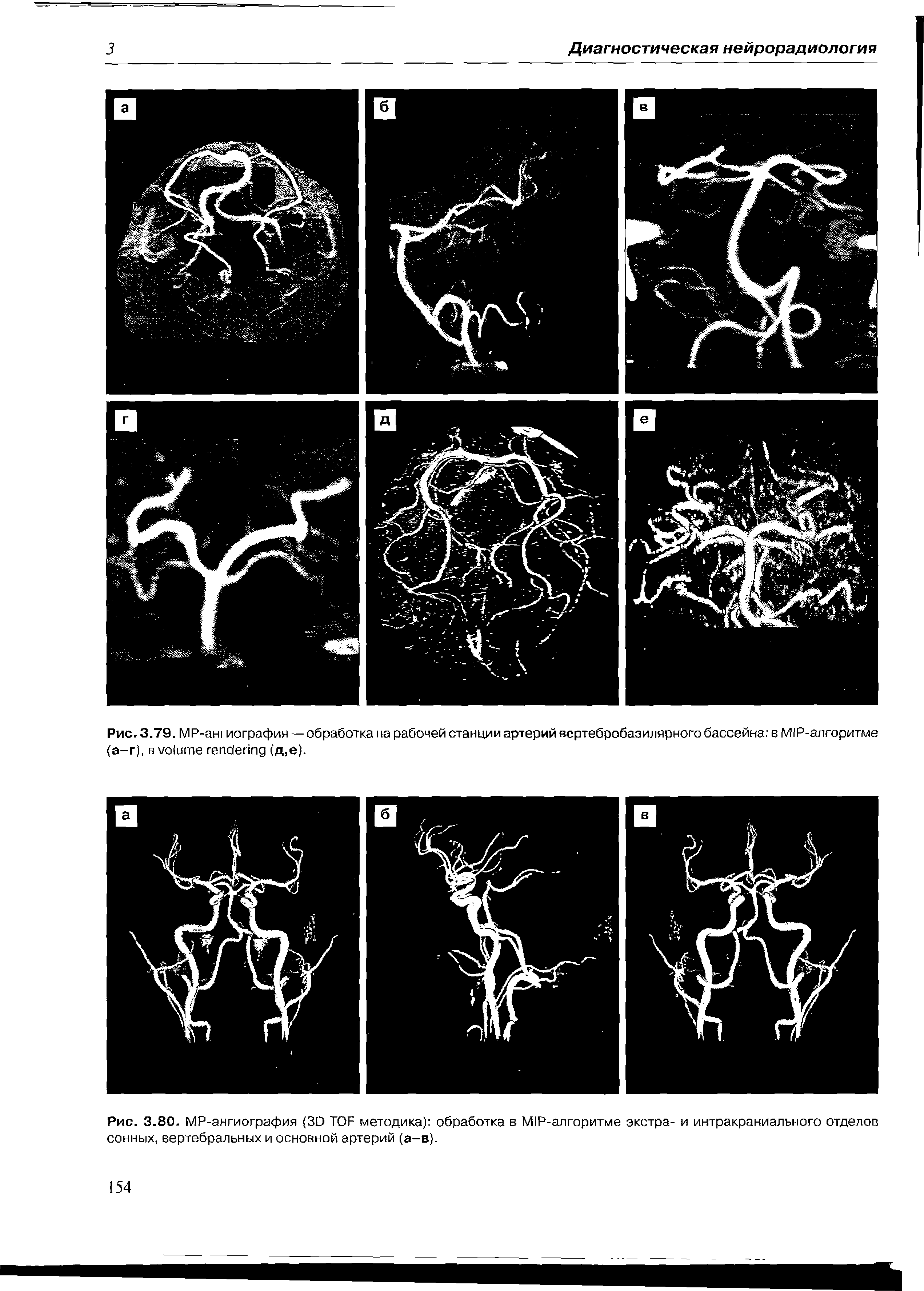Рис. 3.80. МР-ангиография (30 ТОЙ методика) обработка в М1Р-алгоритме экстра- и интракраниального отделов сонных, вертебральных и основной артерий (а-в).