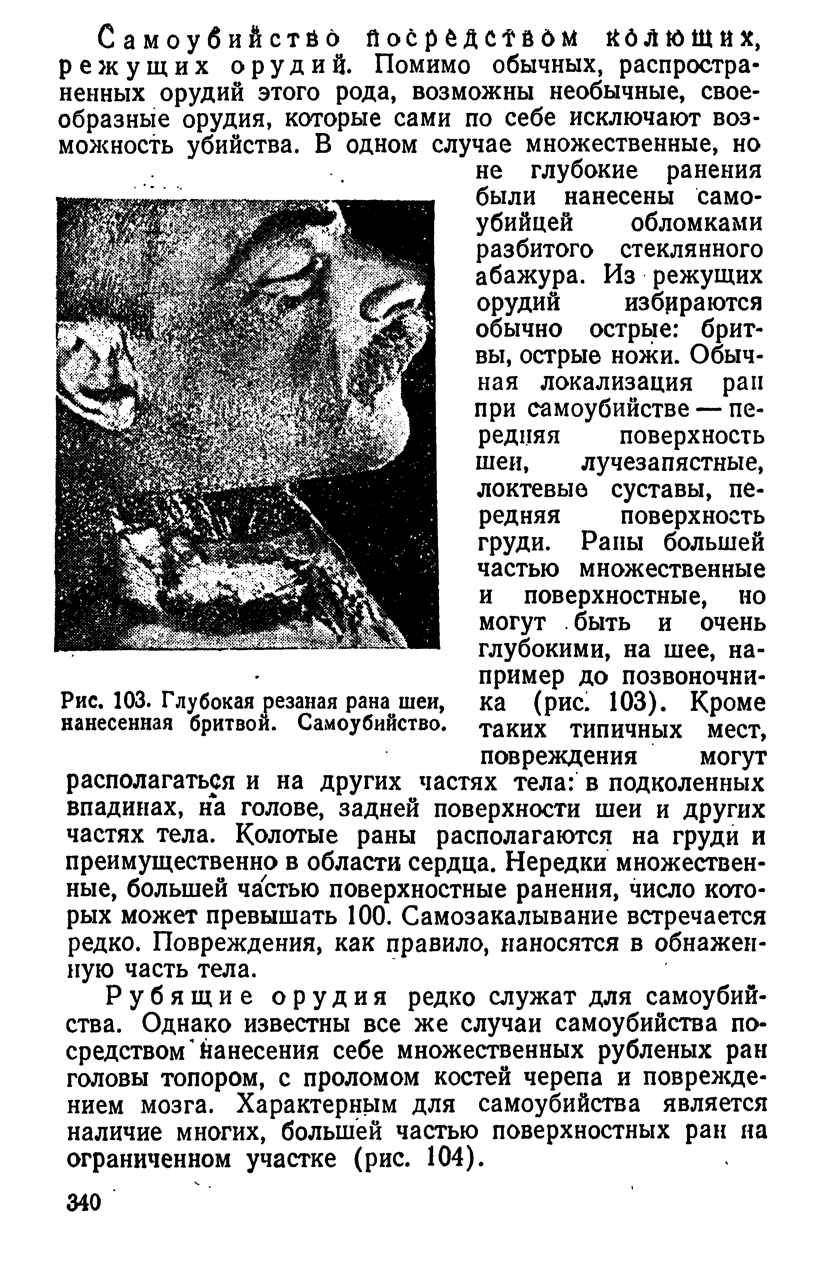 Рис. 103. Глубокая резаная рана шеи, нанесенная бритвой. Самоубийство.