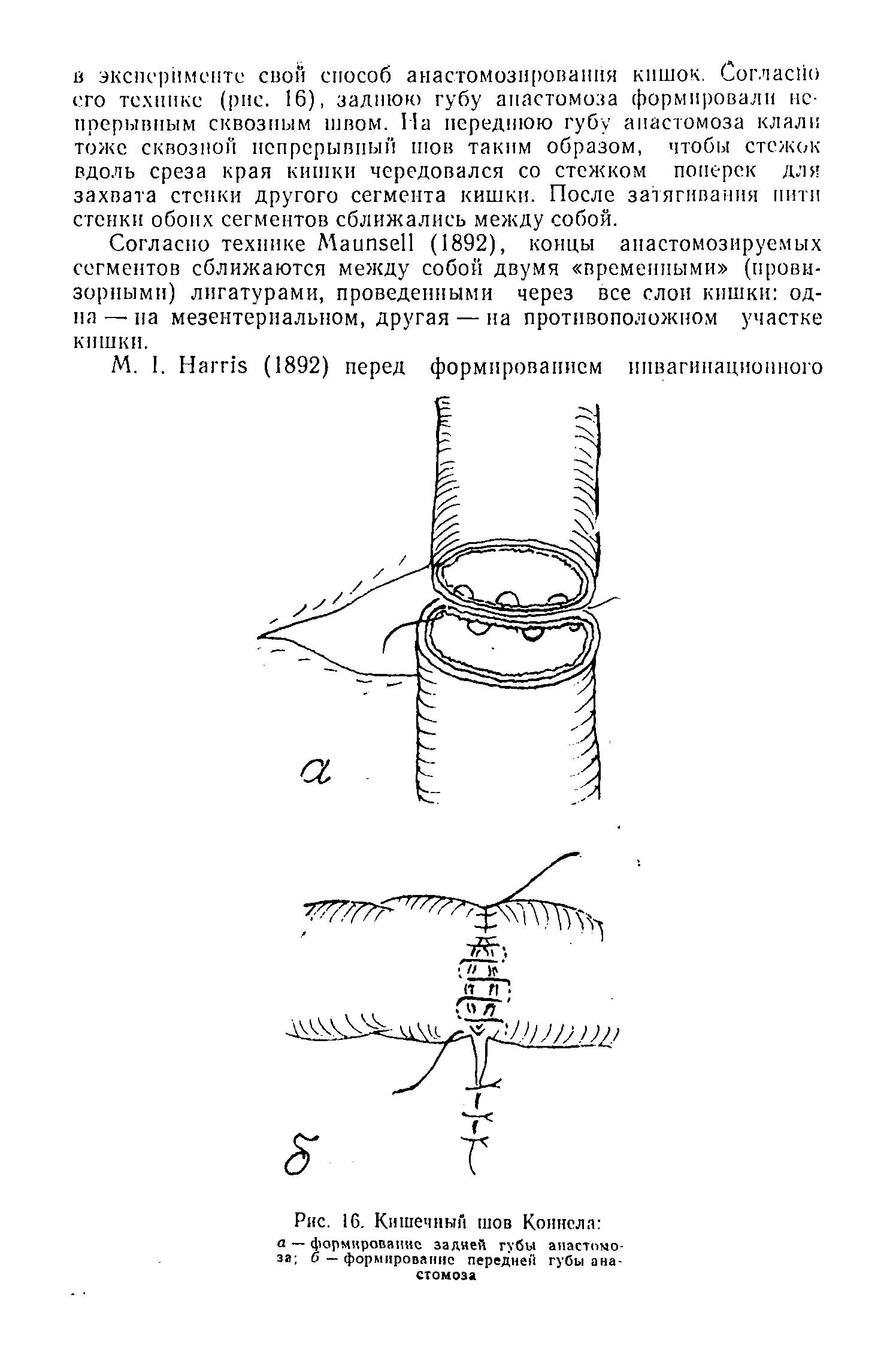 Рис. 16. Кишечный шов Коннела а — формирование задней губы анастомоза б — формирование передней губы анастомоза...