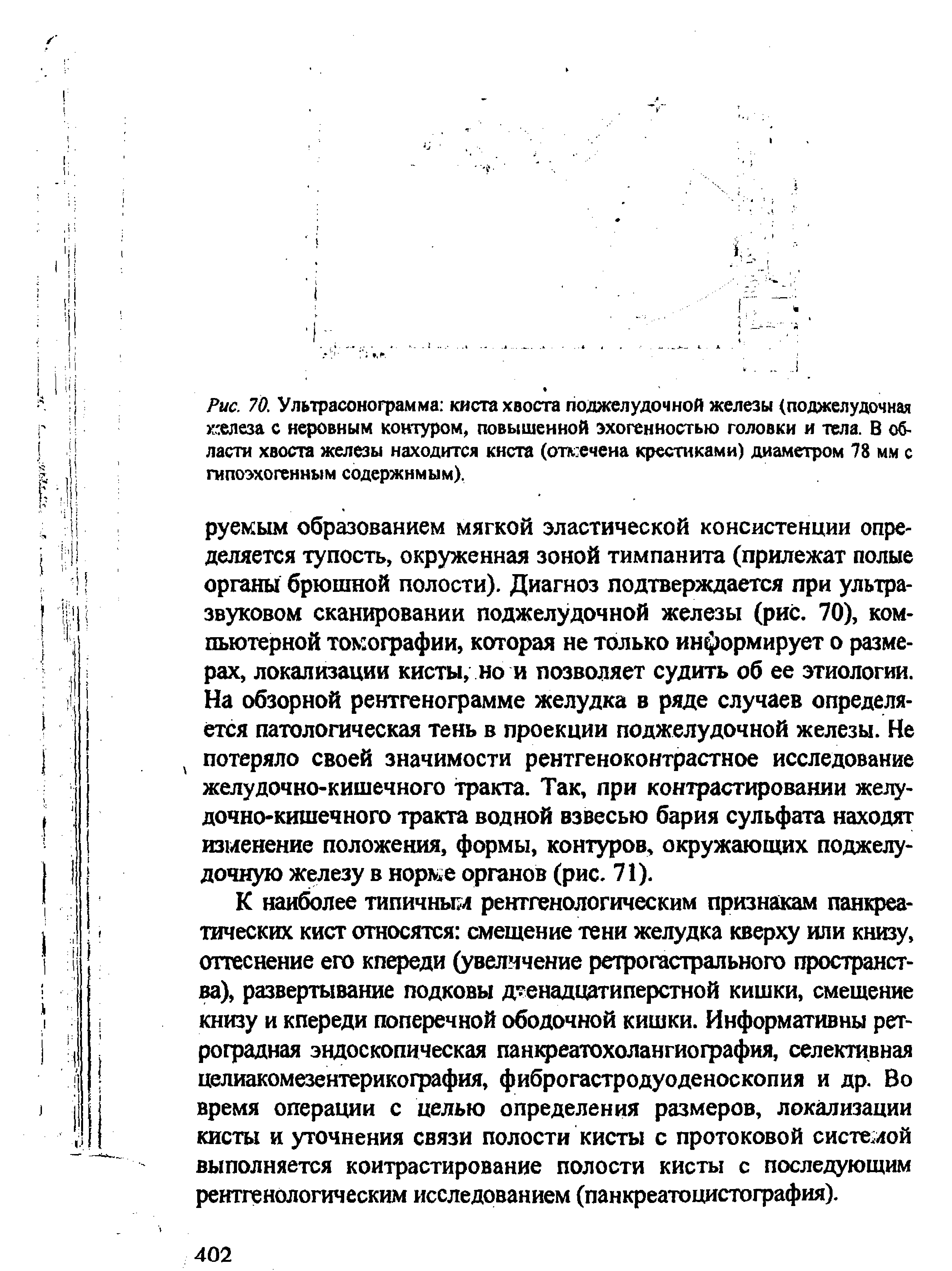 Рис. 70. Ультрасонограмма киста хвоста поджелудочной железы (поджелудочная железа с неровным контуром, повышенной эхогенностью головки и тела. В области хвоста железы находится киста (отвечена крестиками) диаметром 78 мм с гипоэхогенным содержимым).