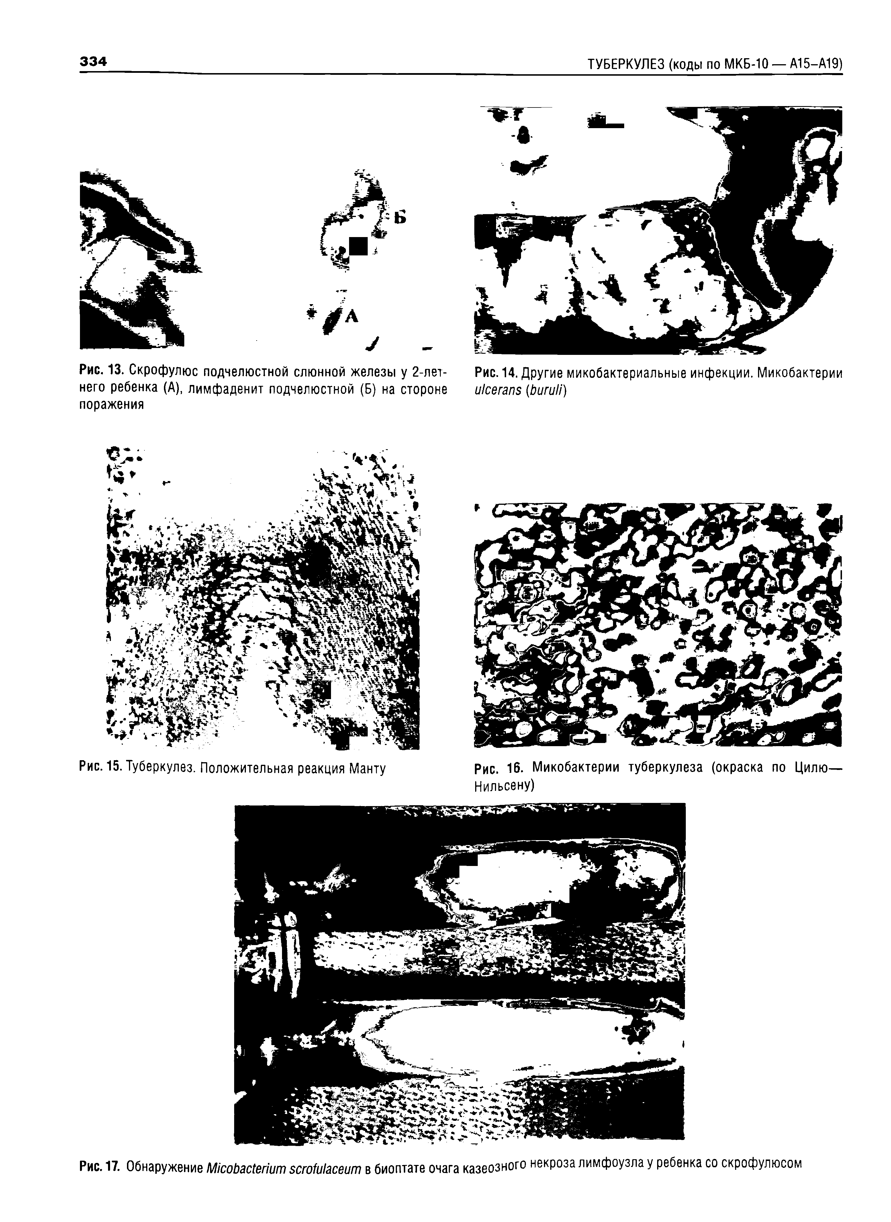 Рис. 13. Скрофулюс подчелюстной слюнной железы у 2-летнего ребенка (А), лимфаденит подчелюстной (Б) на стороне поражения...