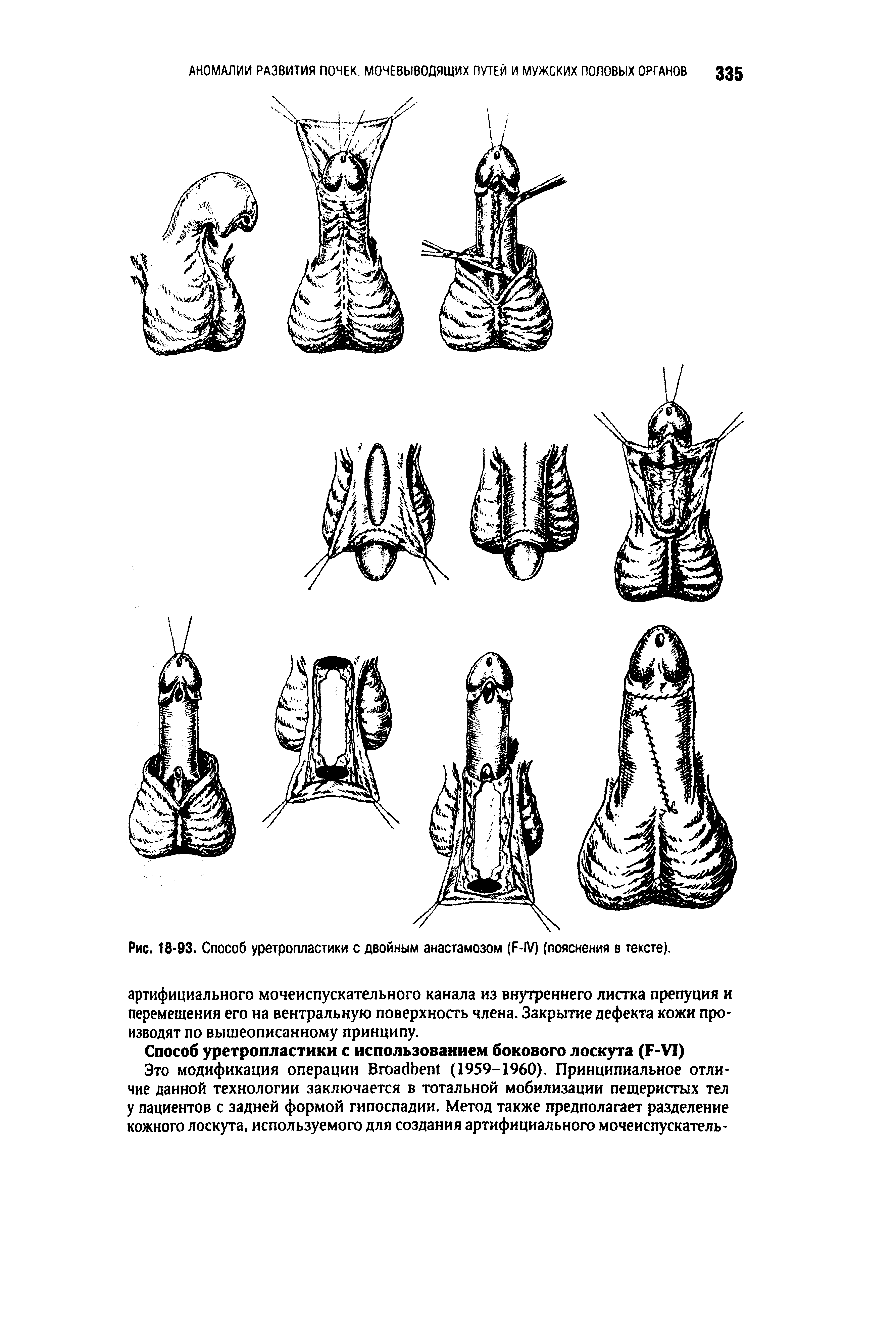 Рис. 18-93. Способ уретропластики с двойным анастамозом (F-IV) (пояснения в тексте).