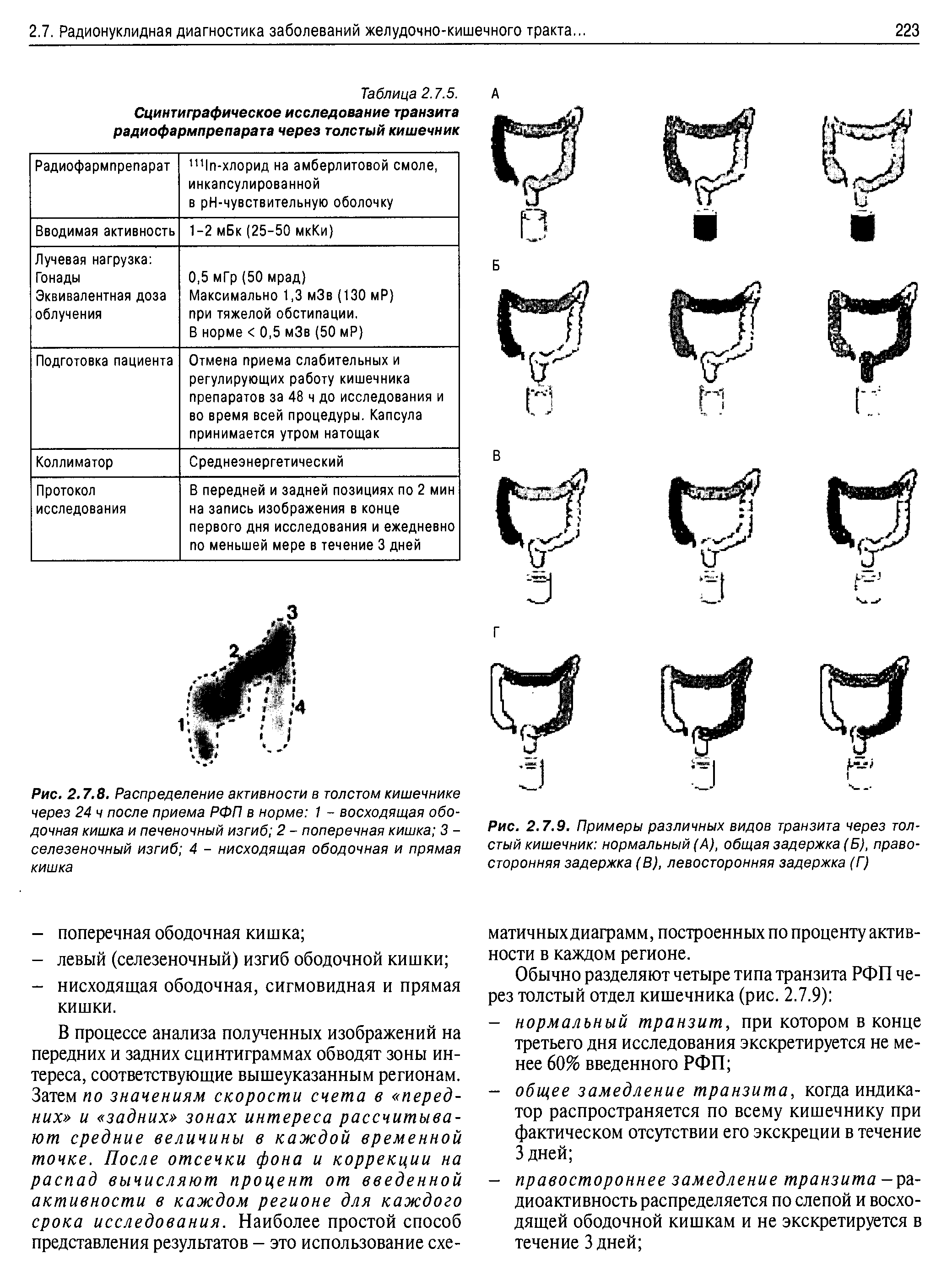 Рис. 2.7.9. Примеры различных видов транзита через толстый кишечник нормальный (А), общая задержка (Б), правосторонняя задержка (В), левосторонняя задержка (Г)...