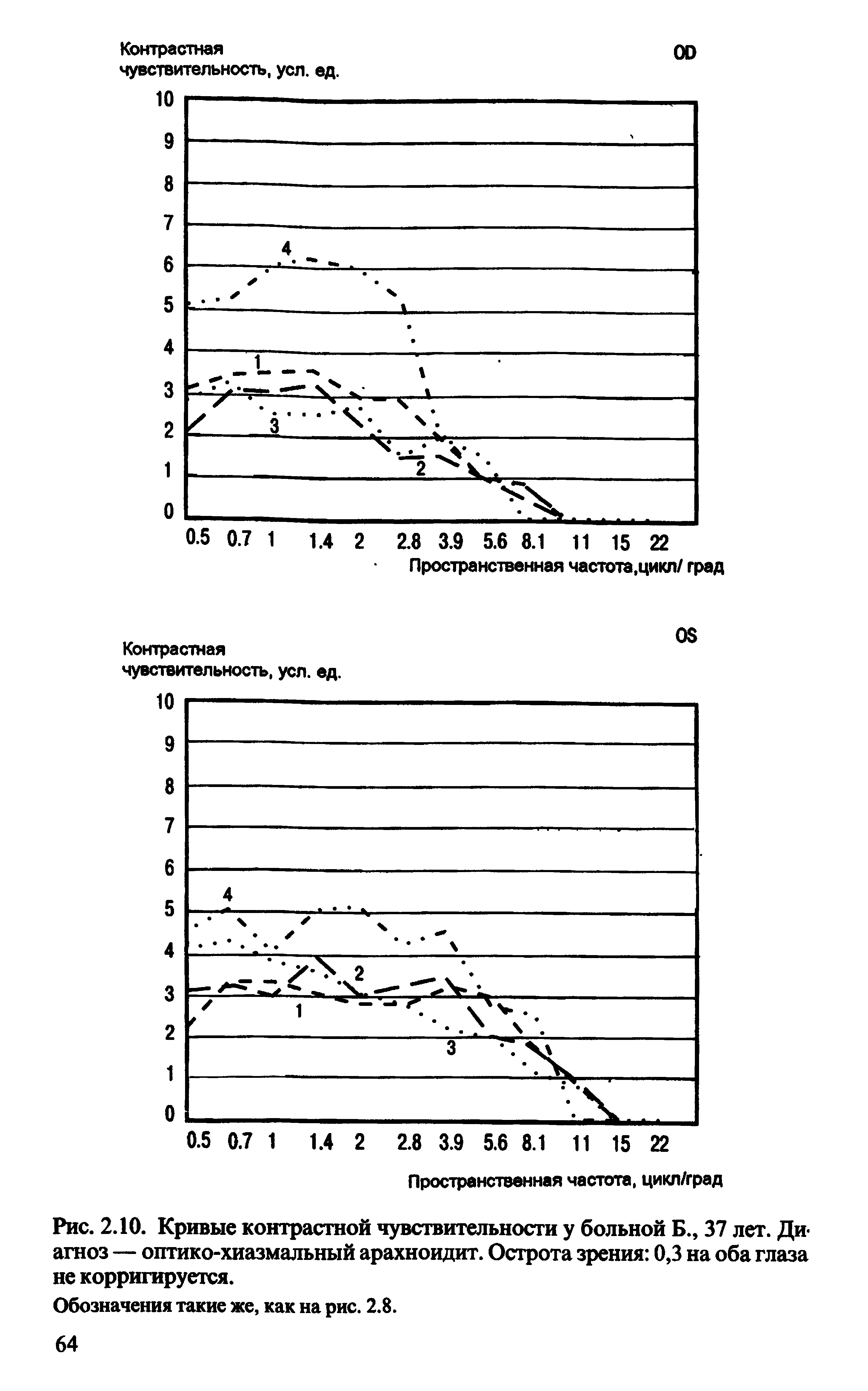 Рис. 2.10. Кривые контрастной чувствительности у больной Б., 37 лет. Диагноз — оптико-хиазмальный арахноидит. Острота зрения 0,3 на оба глаза не корригируется.