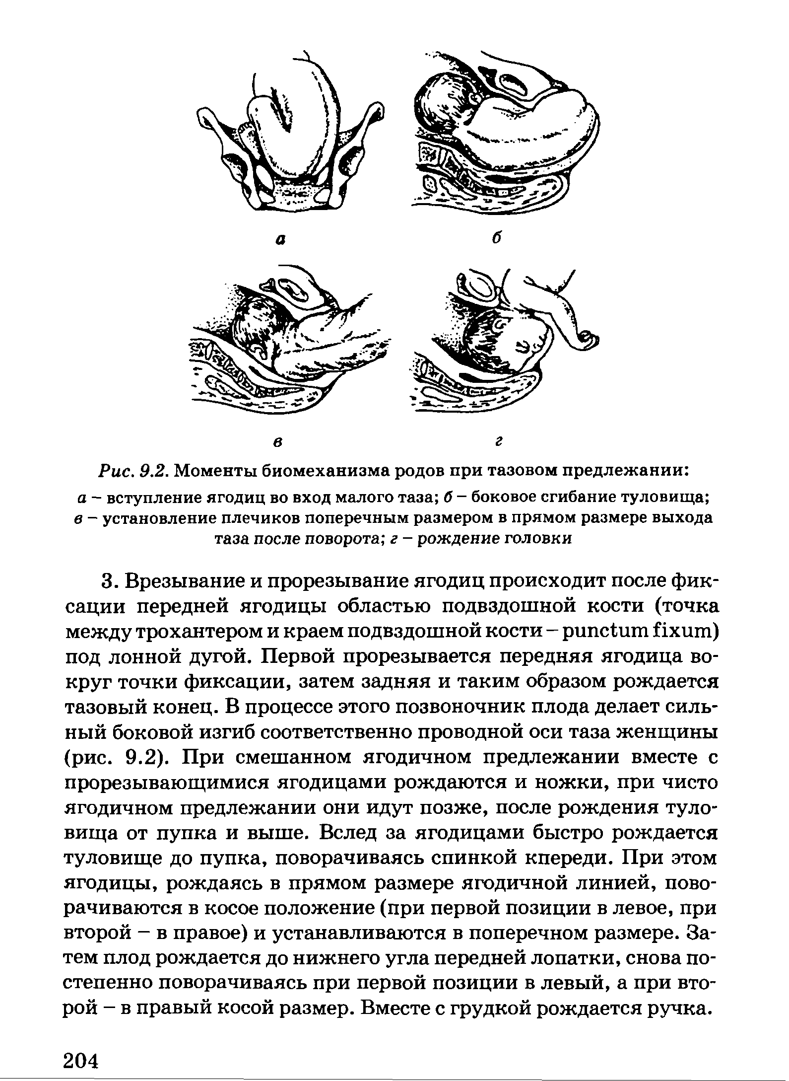 Рис. 9.2. Моменты биомеханизма родов при тазовом предлежании а - вступление ягодиц во вход малого таза б - боковое сгибание туловища в - установление плечиков поперечным размером в прямом размере выхода таза после поворота г - рождение головки...