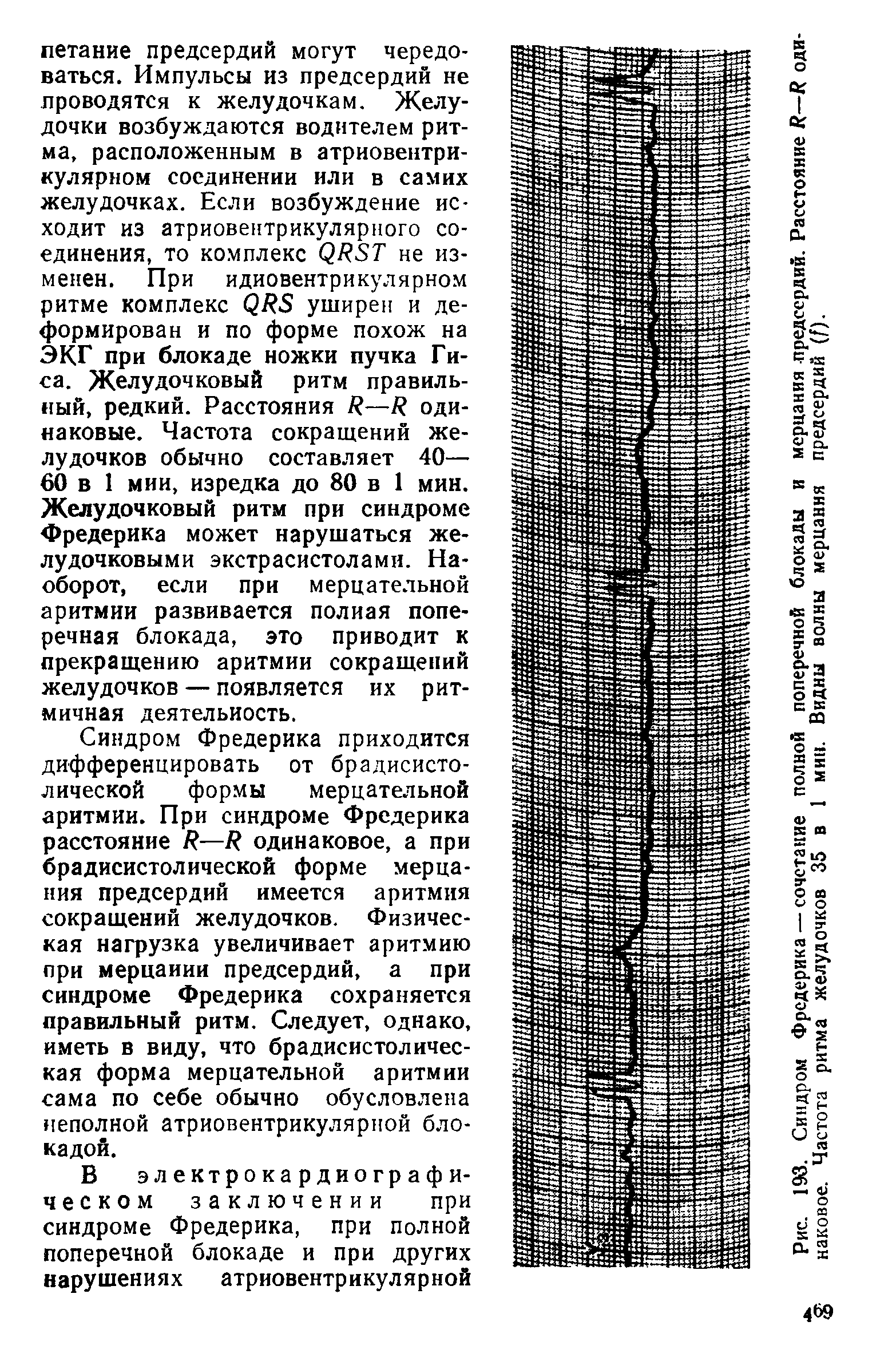 Рис. 193. Синдром Фредерика — сочетание полной поперечной блокады и мерцания предсердий. Расстояние —К одинаковое. Частота ритма желудочков 35 в 1 мин. Видны волны мерцания предсердий (0.