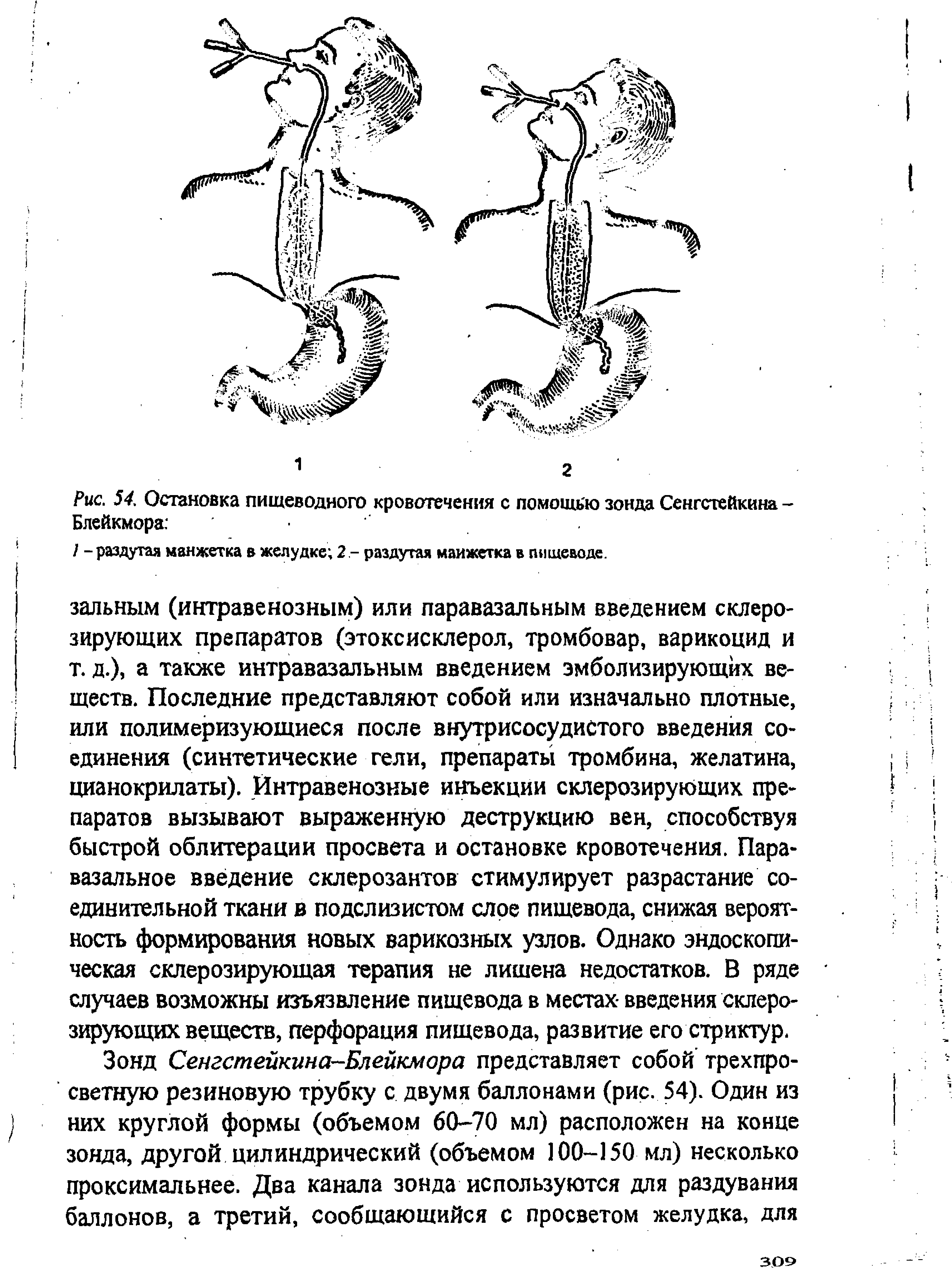 Рис. 54. Остановка пищеводного кровотечения с помощью зонда Сенгстейкина -Блейкмора ...