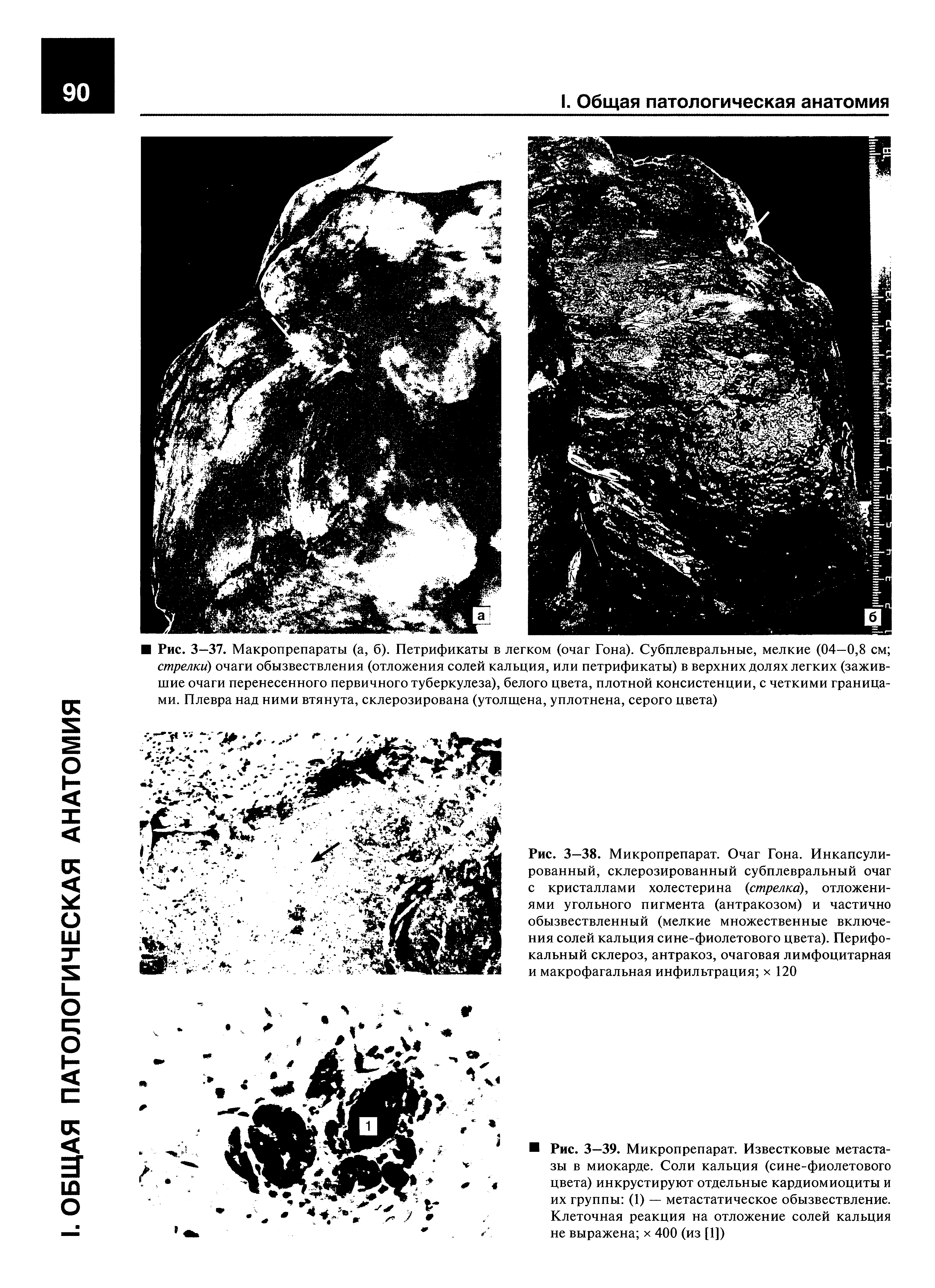 Рис. 3—38. Микропрепарат. Очаг Гона. Инкапсулированный, склерозированный субплевральный очаг с кристаллами холестерина (стрелка), отложениями угольного пигмента (антракозом) и частично обызвествленный (мелкие множественные включения солей кальция сине-фиолетового цвета). Перифокальный склероз, антракоз, очаговая лимфоцитарная и макрофагальная инфильтрация х 120...