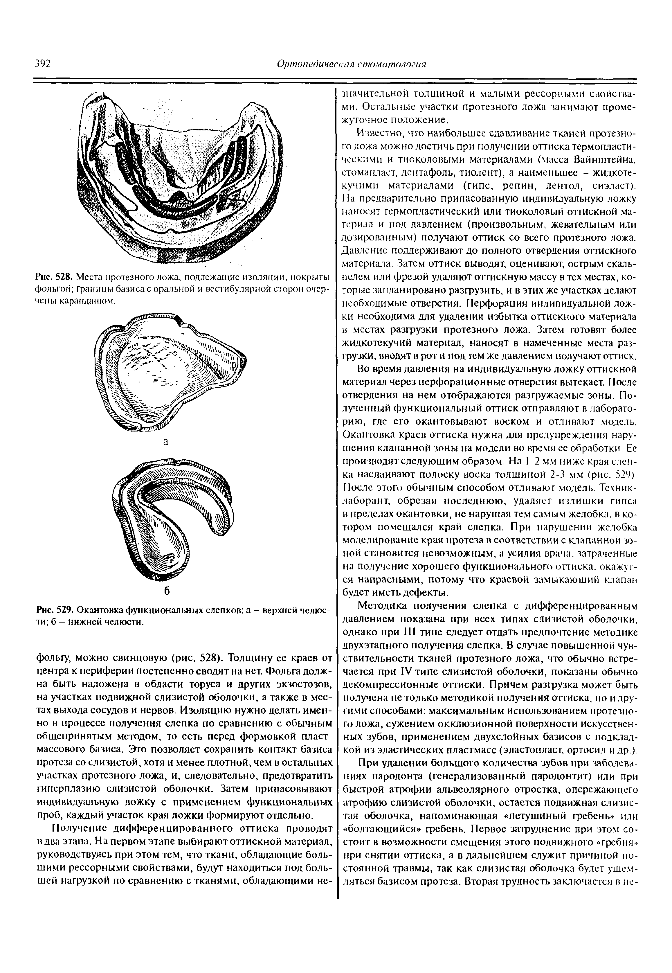 Рис. 529. Окантовка функциональных слепков а - верхней челюсти б - нижней челюсти.