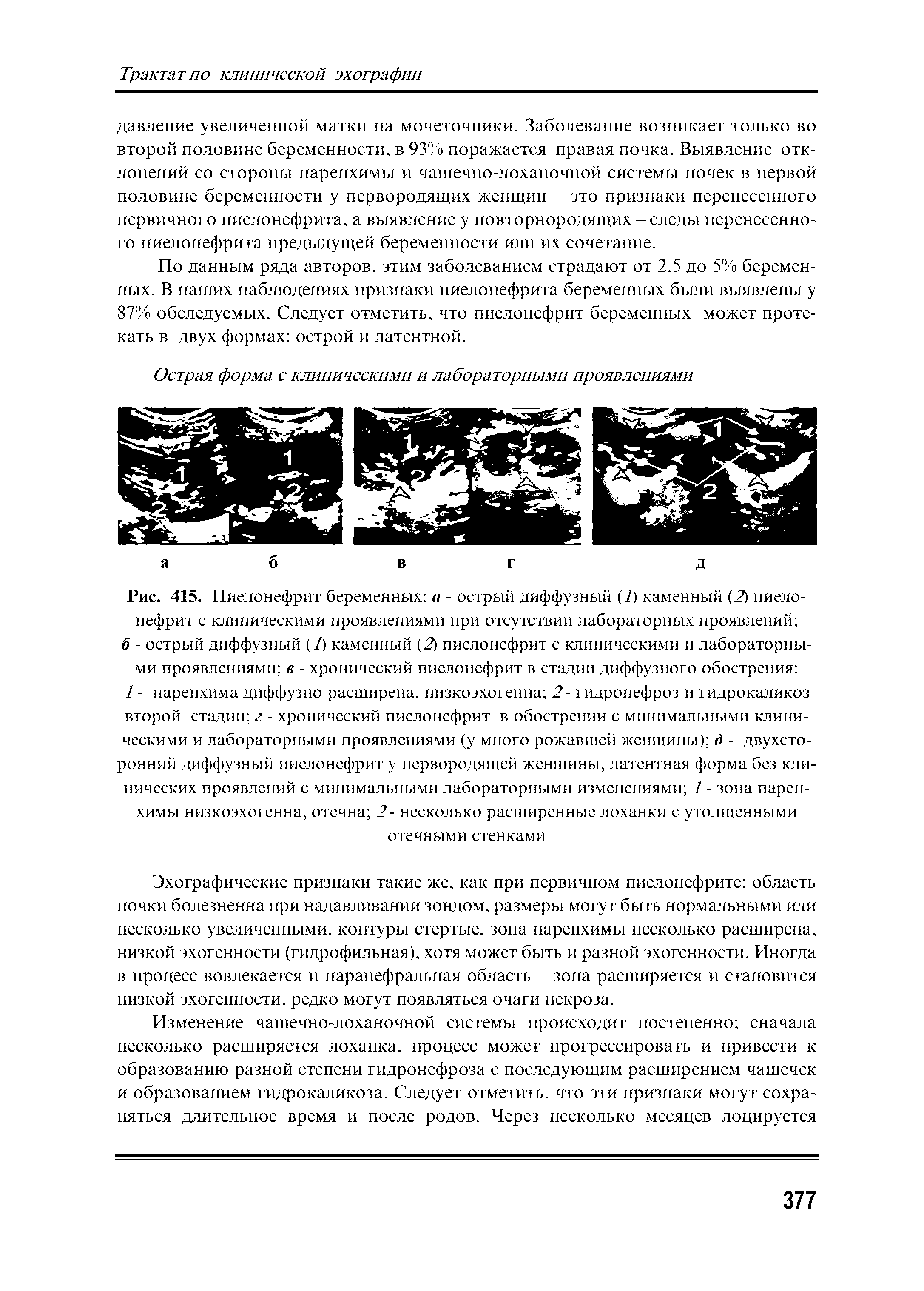 Рис. 415. Пиелонефрит беременных а - острый диффузный (/) каменный (2) пиелонефрит с клиническими проявлениями при отсутствии лабораторных проявлений ...