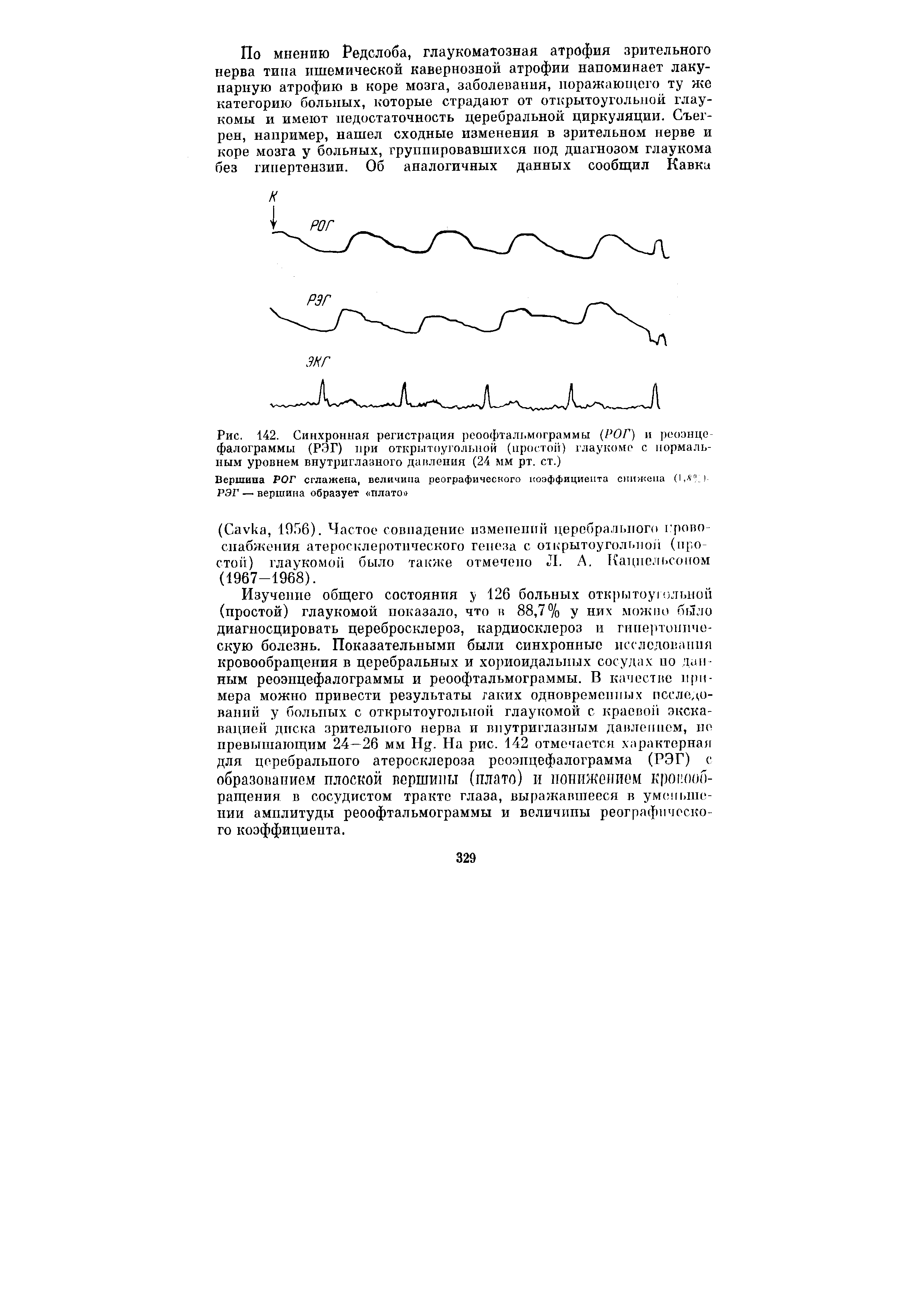 Рис. 142. Синхронная регистрация реоофтальмограммы (РОГ) и реоэнцс-фалограммы (РЭГ) при открытоугольной (простой) глаукоме с нормальным уровнем внутриглазного давления (24 мм рт. ст.)...