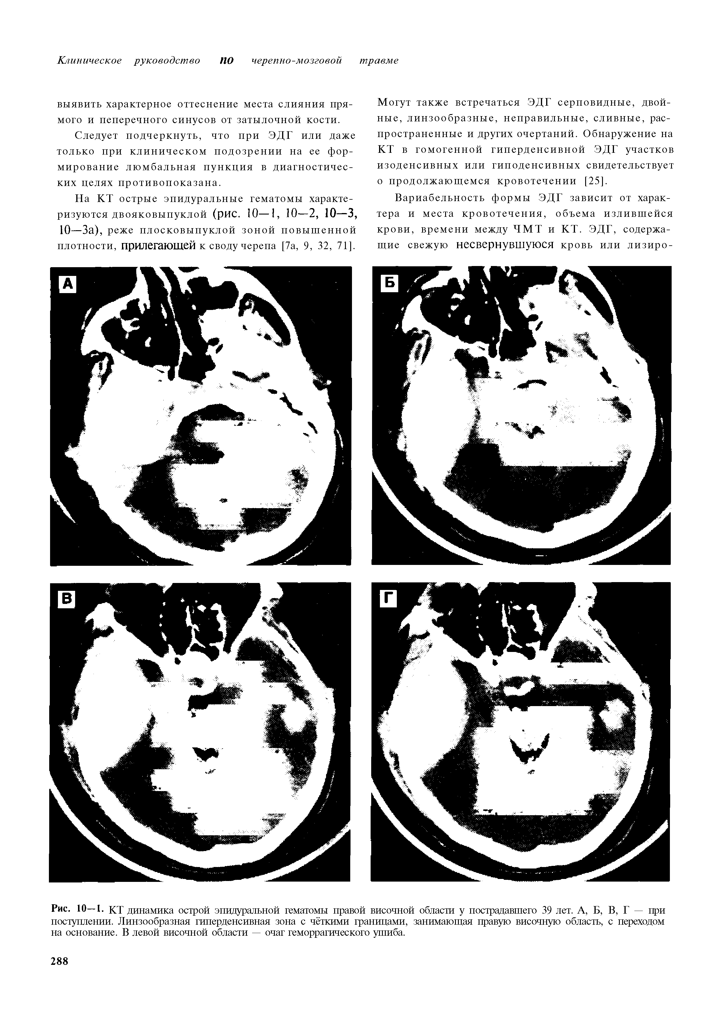 Рис. 10—1. КТ динамика острой эпидуральной гематомы правой височной области у пострадавшего 39 лет. А, Б, В, Г — при поступлении. Линзообразная гиперденсивная зона с чёткими границами, занимающая правую височную область, с переходом на основание. В левой височной области — очаг геморрагического ушиба.