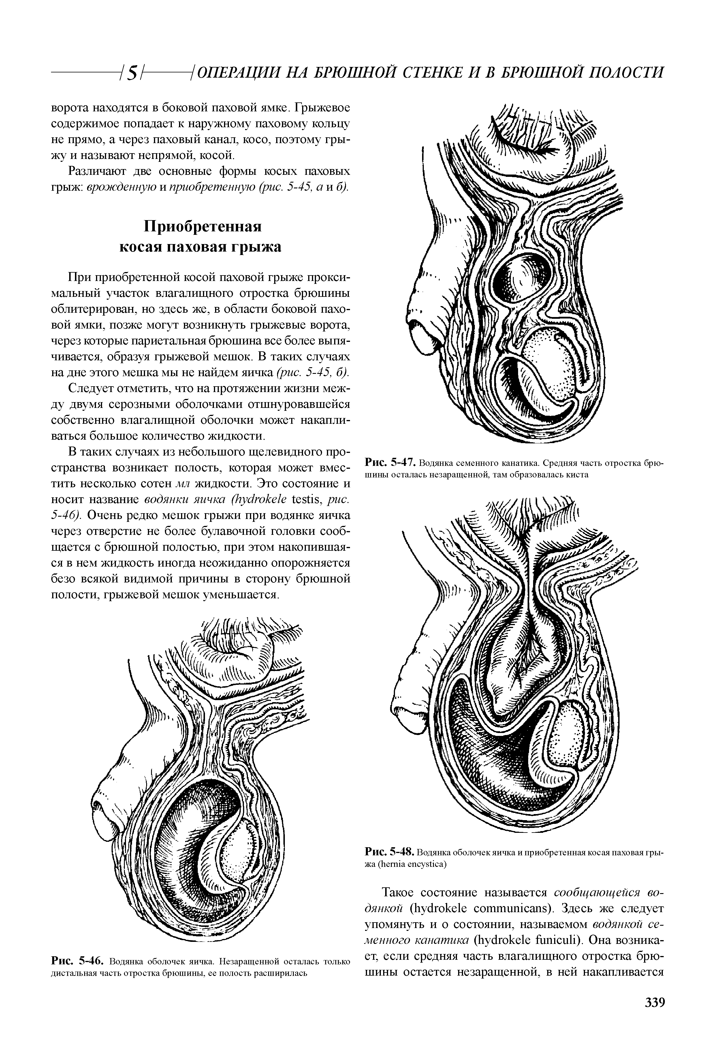 Рис. 5-48. Водянка оболочек яичка и приобретенная косая паховая грыжа ( )...
