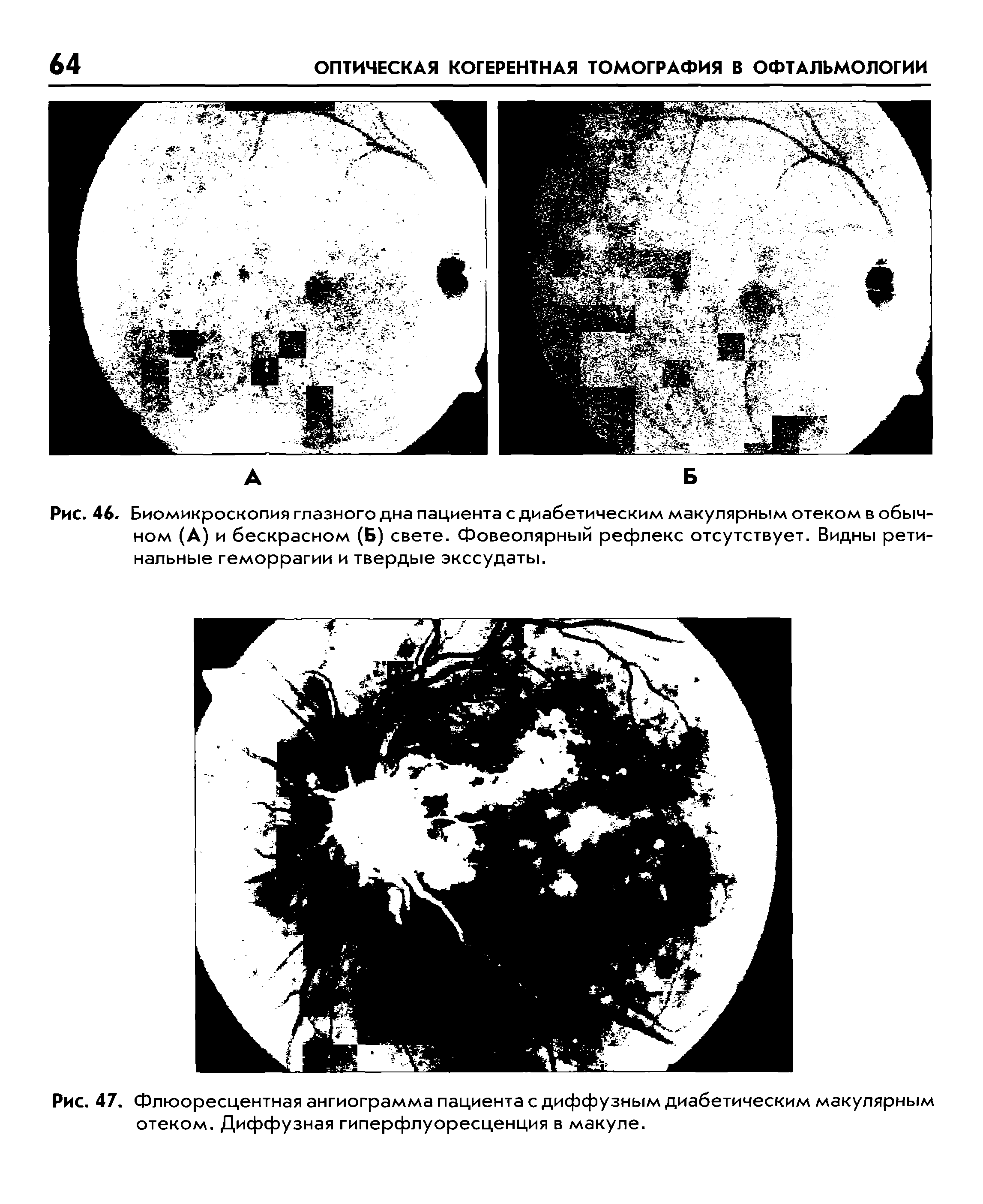 Рис. 47. Флюоресцентная ангиограмма пациента с диффузным диабетическим макулярным отеком. Диффузная гиперфлуоресценция в макуле.