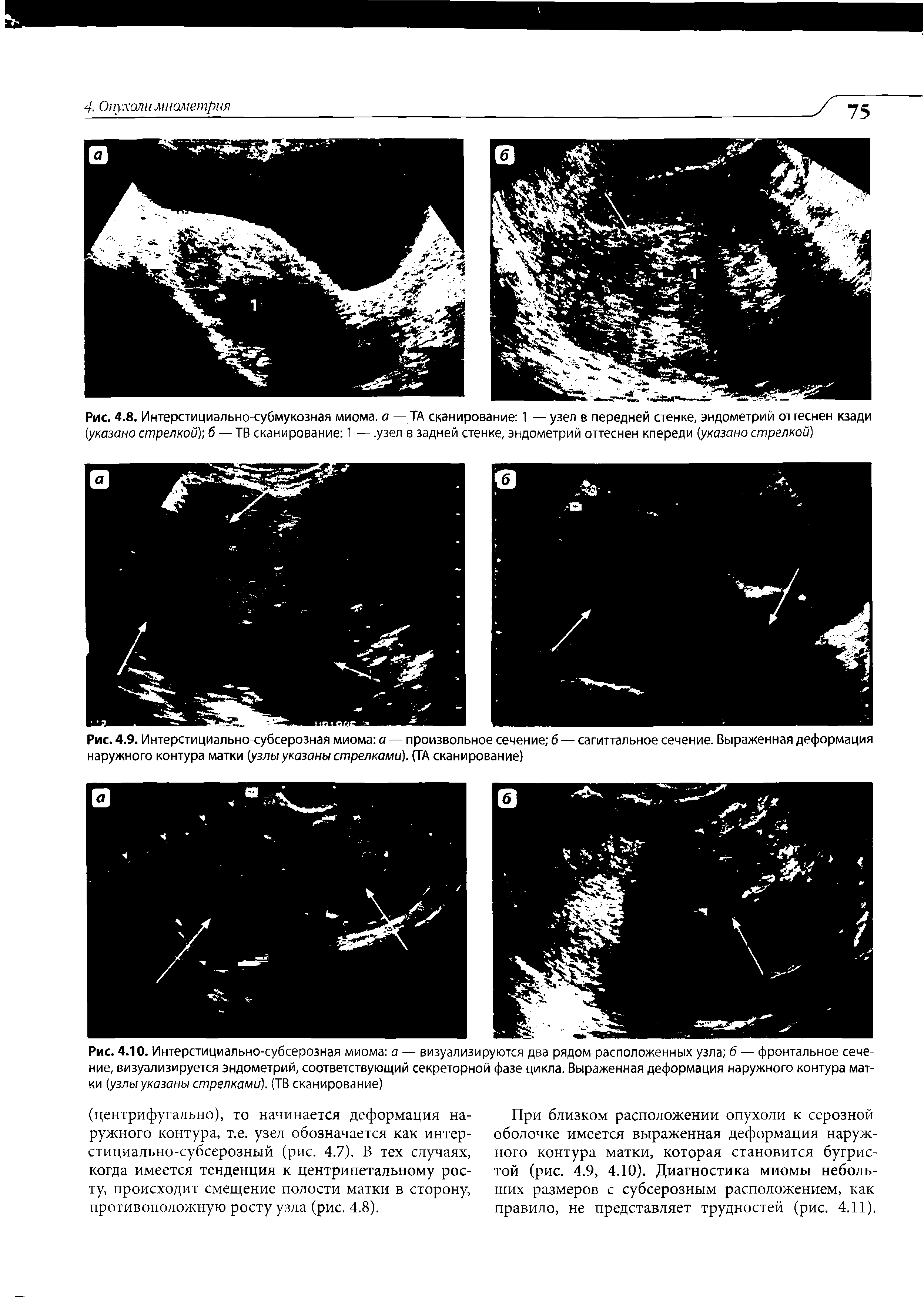 Рис. 4.9. Интерстициально-субсерозная миома а — произвольное сечение б — сагиттальное сечение. Выраженная деформация наружного контура матки узлы указаны стрелками. (ТА сканирование)...