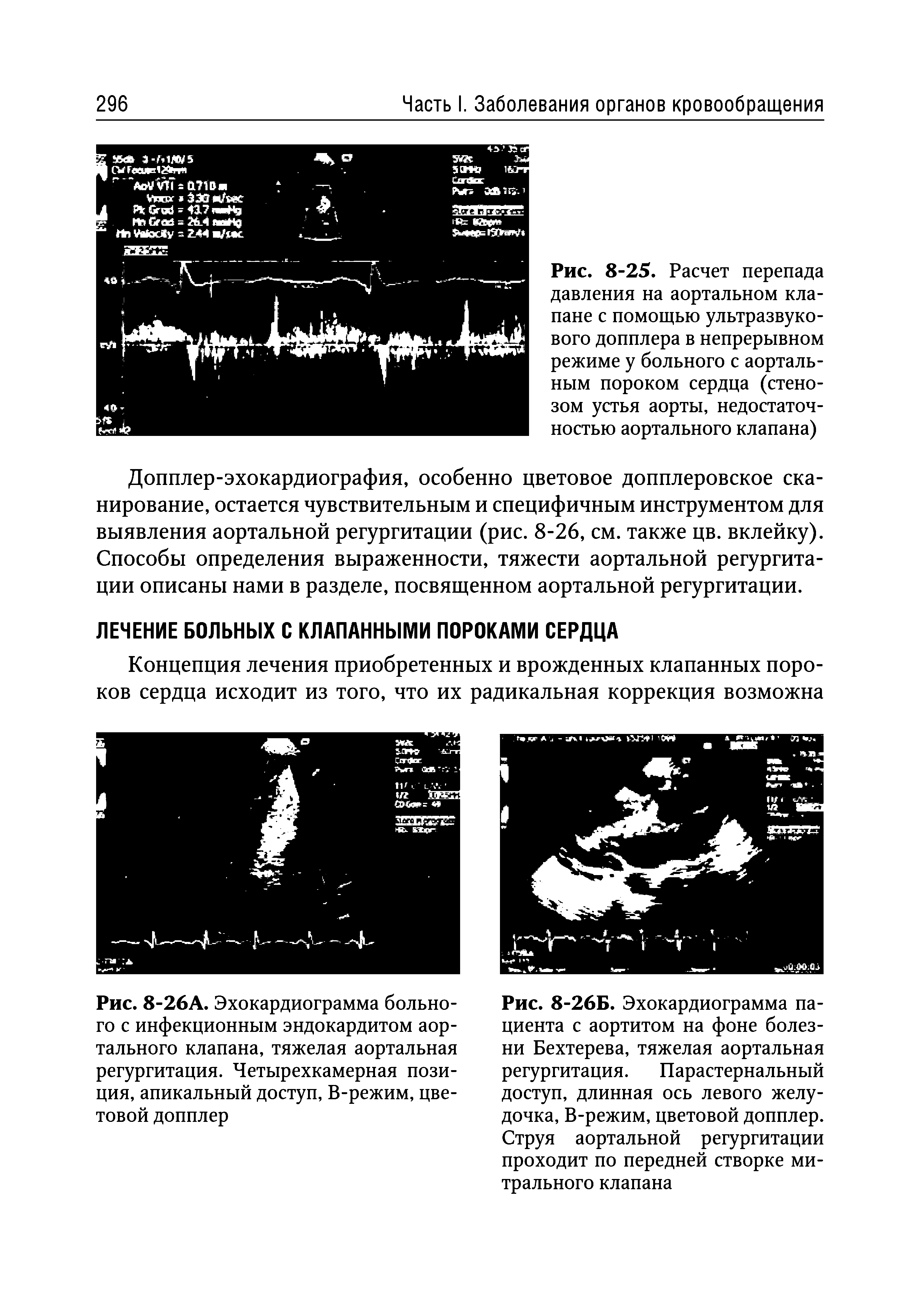 Рис. 8-26Б. Эхокардиограмма пациента с аортитом на фоне болезни Бехтерева, тяжелая аортальная регургитация. Парастернальный доступ, длинная ось левого желудочка, В-режим, цветовой допплер. Струя аортальной регургитации проходит по передней створке ми-...