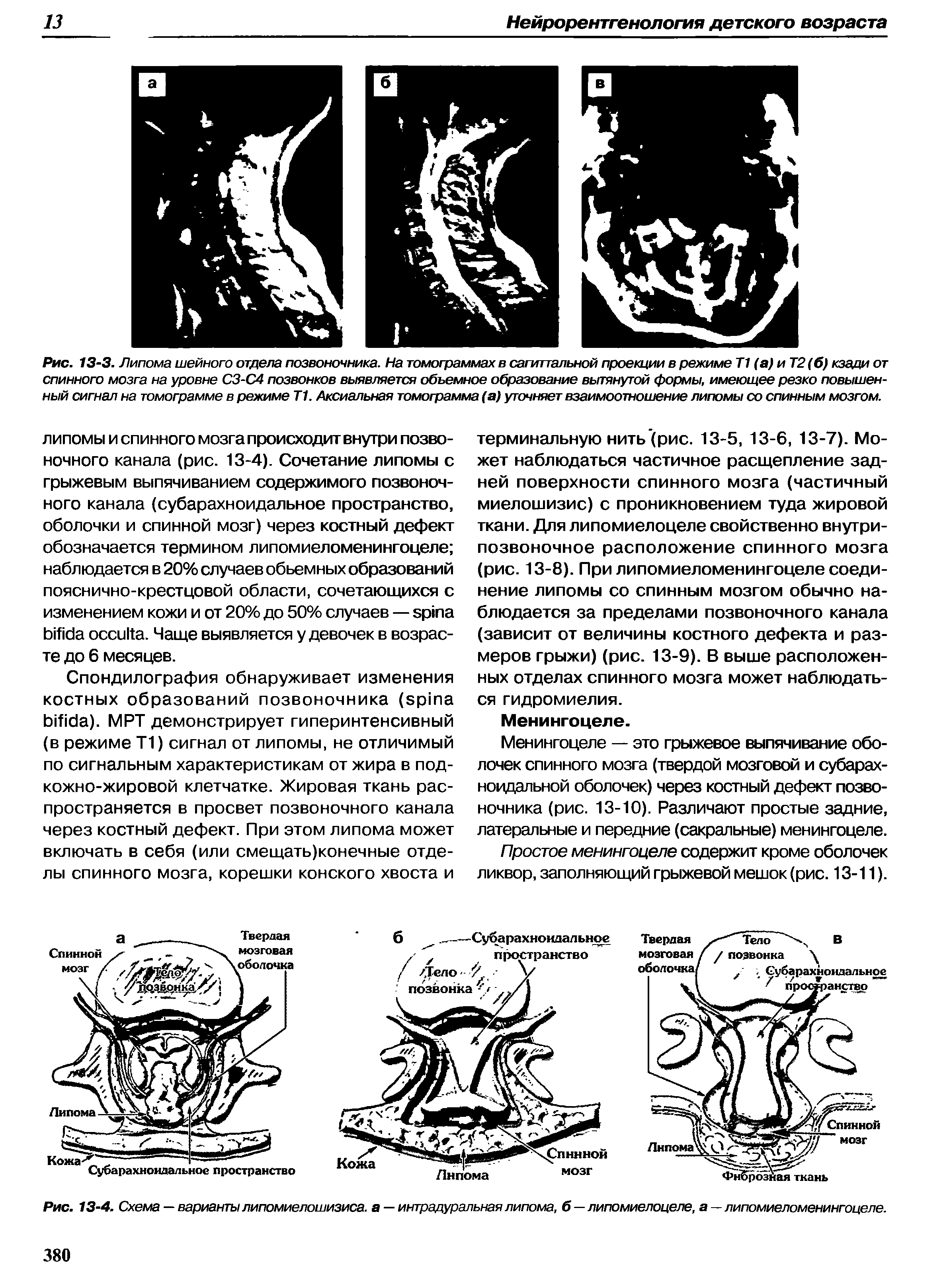 Рис. 13-4. Схема — варианты липомиелошизиса. а — интрадуральная липома, б — липомиелоцеле, а — липомиеломенингоцеле.