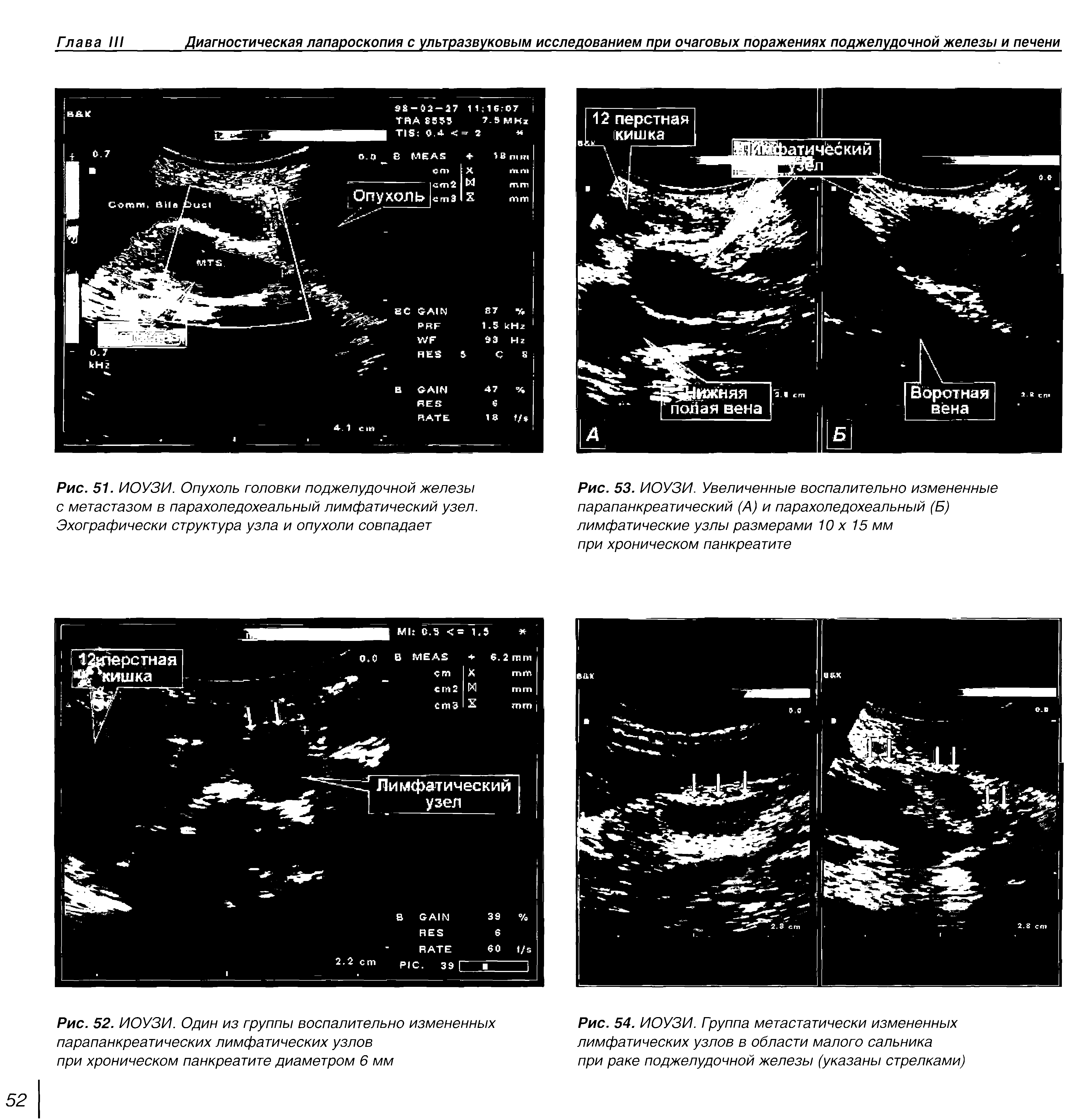 Рис. 51. ИОУЗИ. Опухоль головки поджелудочной железы с метастазом в парахоледохеальный лимфатический узел. Эхографически структура узла и опухоли совпадает...