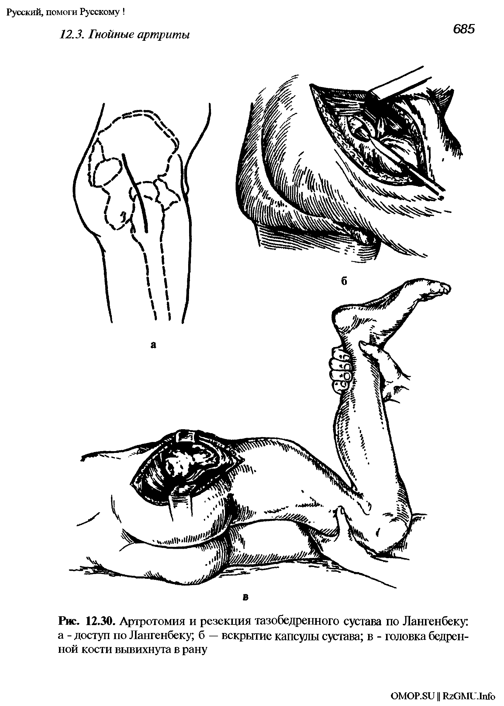Рис. 12.30. Артротомия и резекция тазобедренного сустава по Лангенбеку а - доступ по Лангенбеку б — вскрытие капсулы сустава в - головка бедренной кости вывихнута в рану...