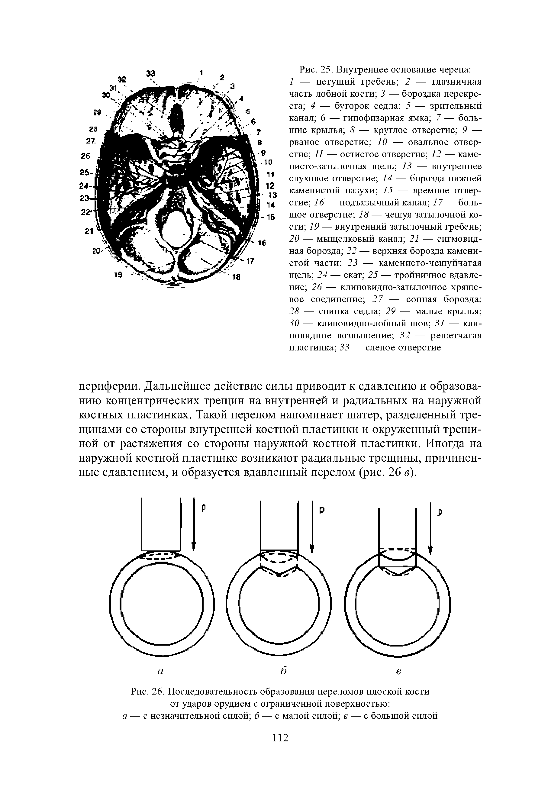 Рис. 26. Последовательность образования переломов плоской кости от ударов орудием с ограниченной поверхностью а — с незначительной силой б — с малой силой в — с большой силой...