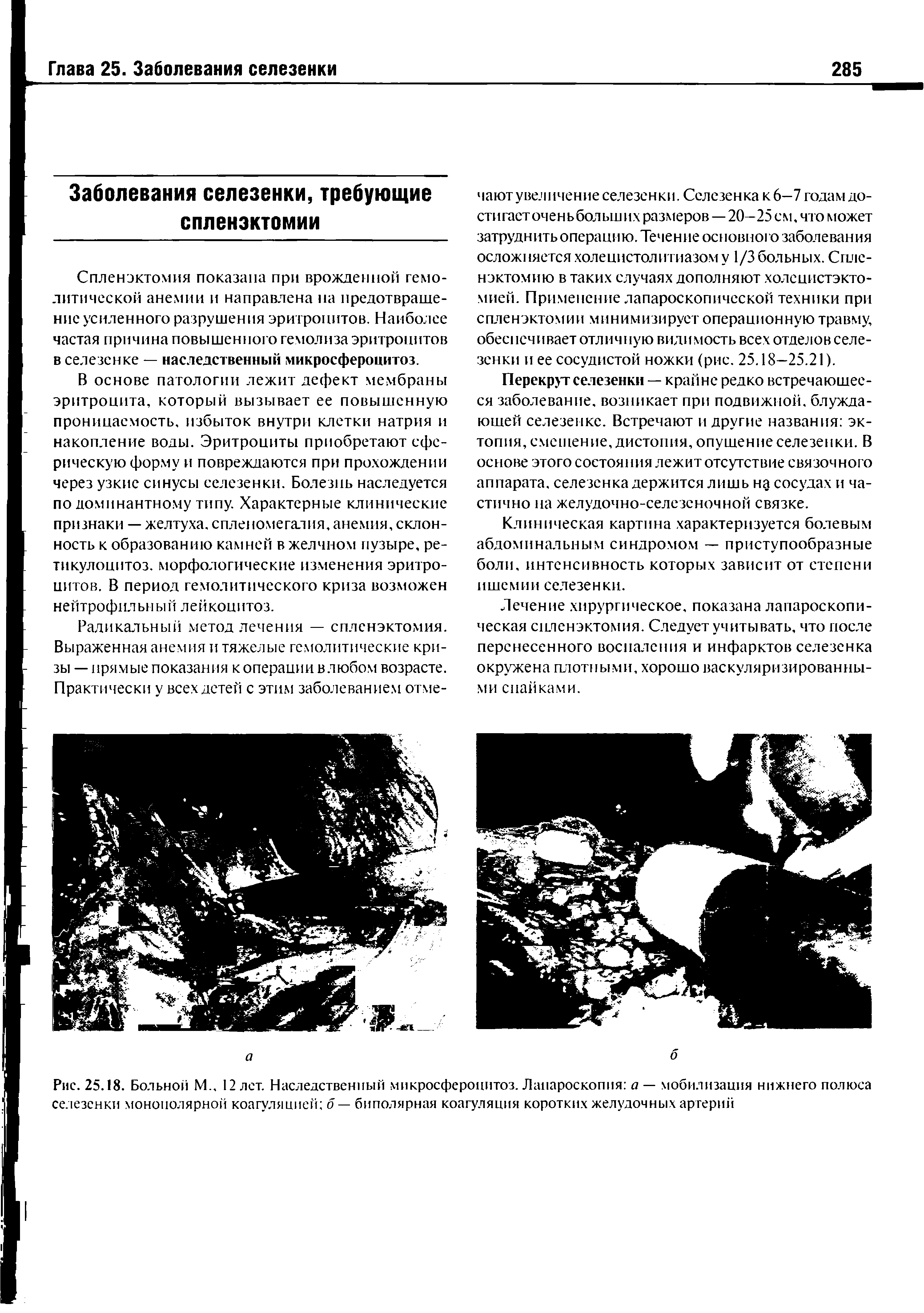 Рис. 25.18. Больной М., 12 лет. Наследственный микросфероцитоз. Лапароскопия а — мобилизация нижнего полюса селезенки монополярной коагуляцией о — биполярная коагуляция коротких желудочных артерий...