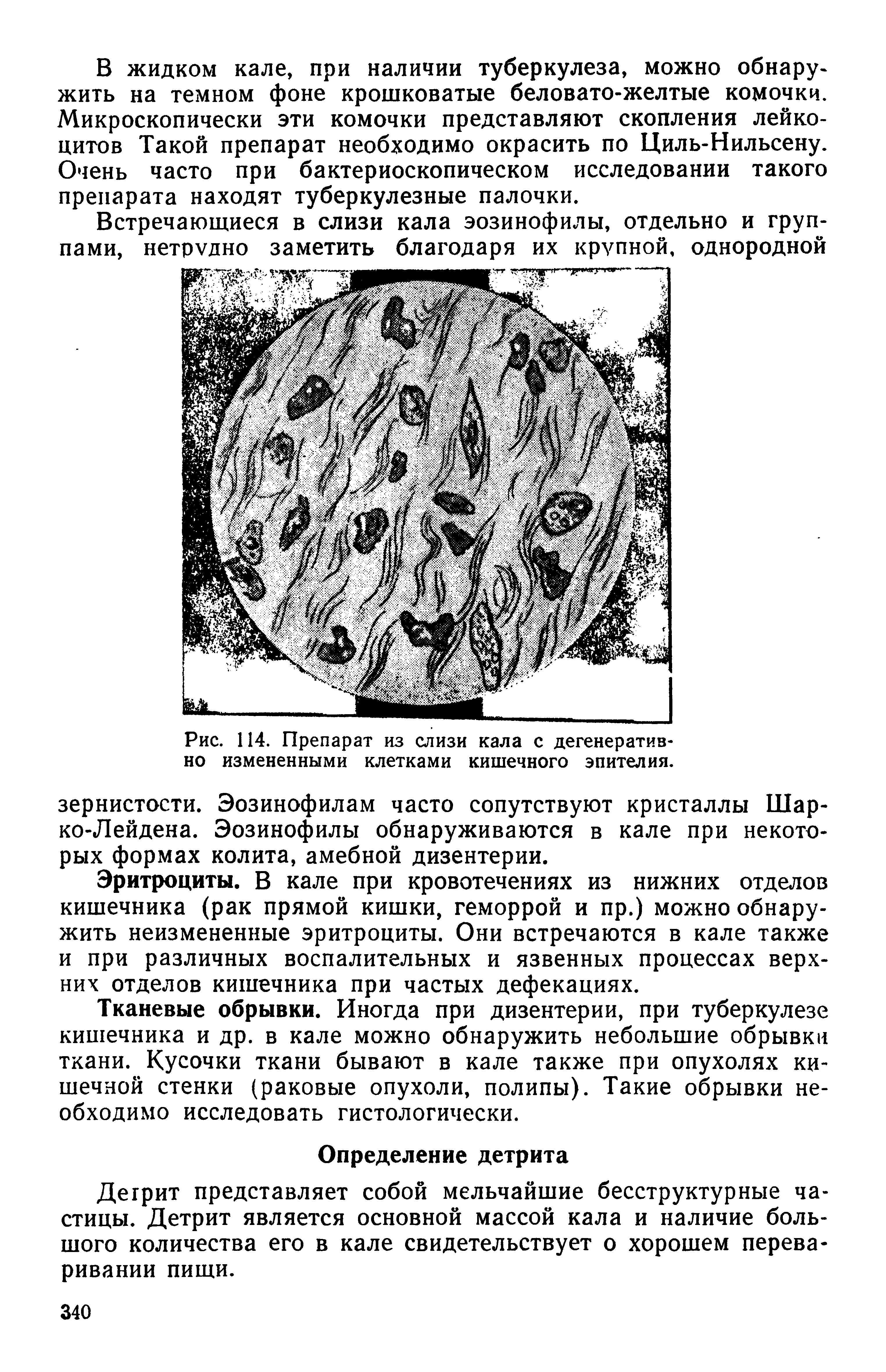 Рис. 114. Препарат из слизи кала с дегенеративно измененными клетками кишечного эпителия.