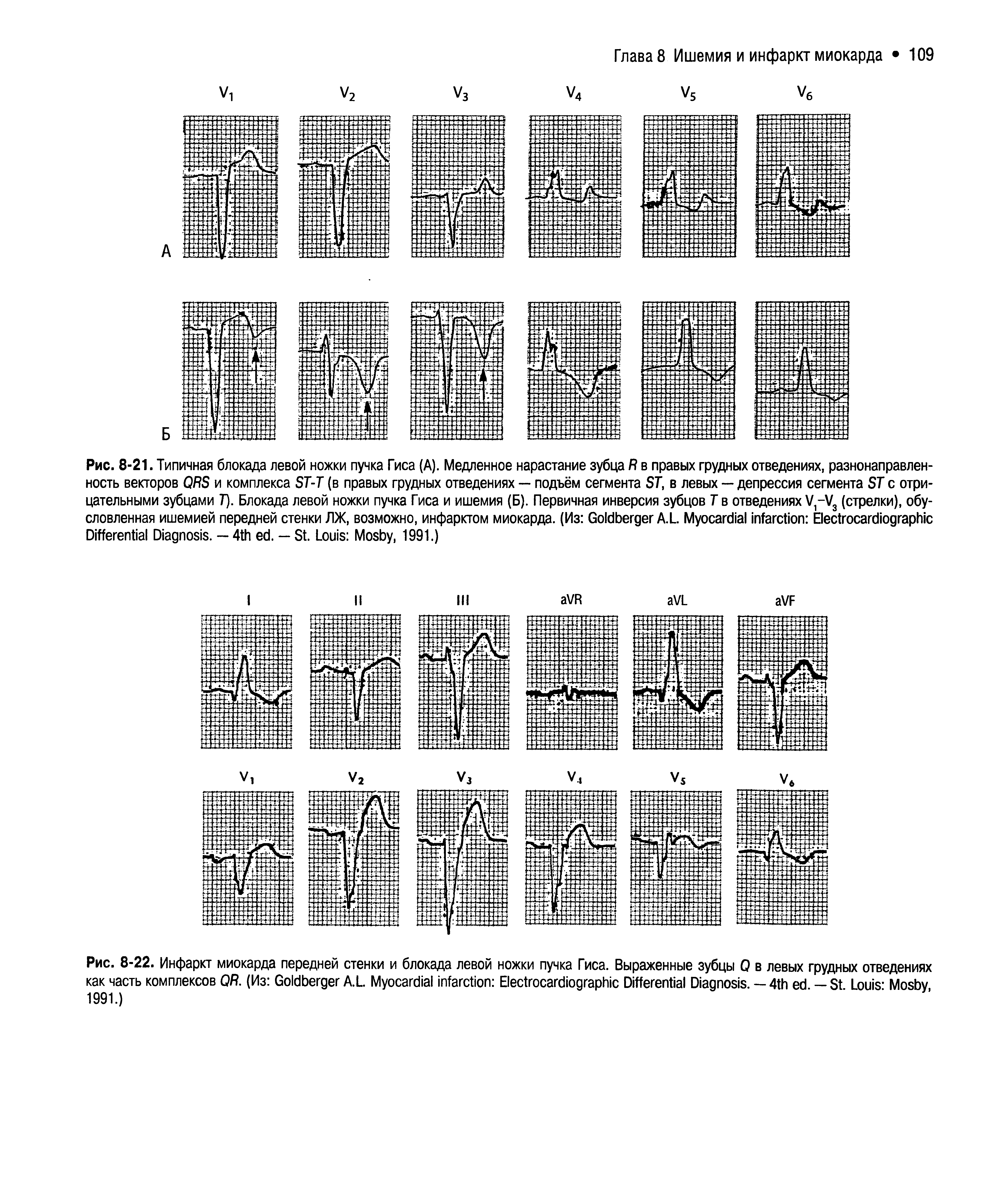 Рис. 8-22. Инфаркт миокарда передней стенки и блокада левой ножки пучка Гиса. Выраженные зубцы Q в левых грудных отведениях как часть комплексов QR. (Из G A.L. M E D D . — 4 — S L - M 1991.)...