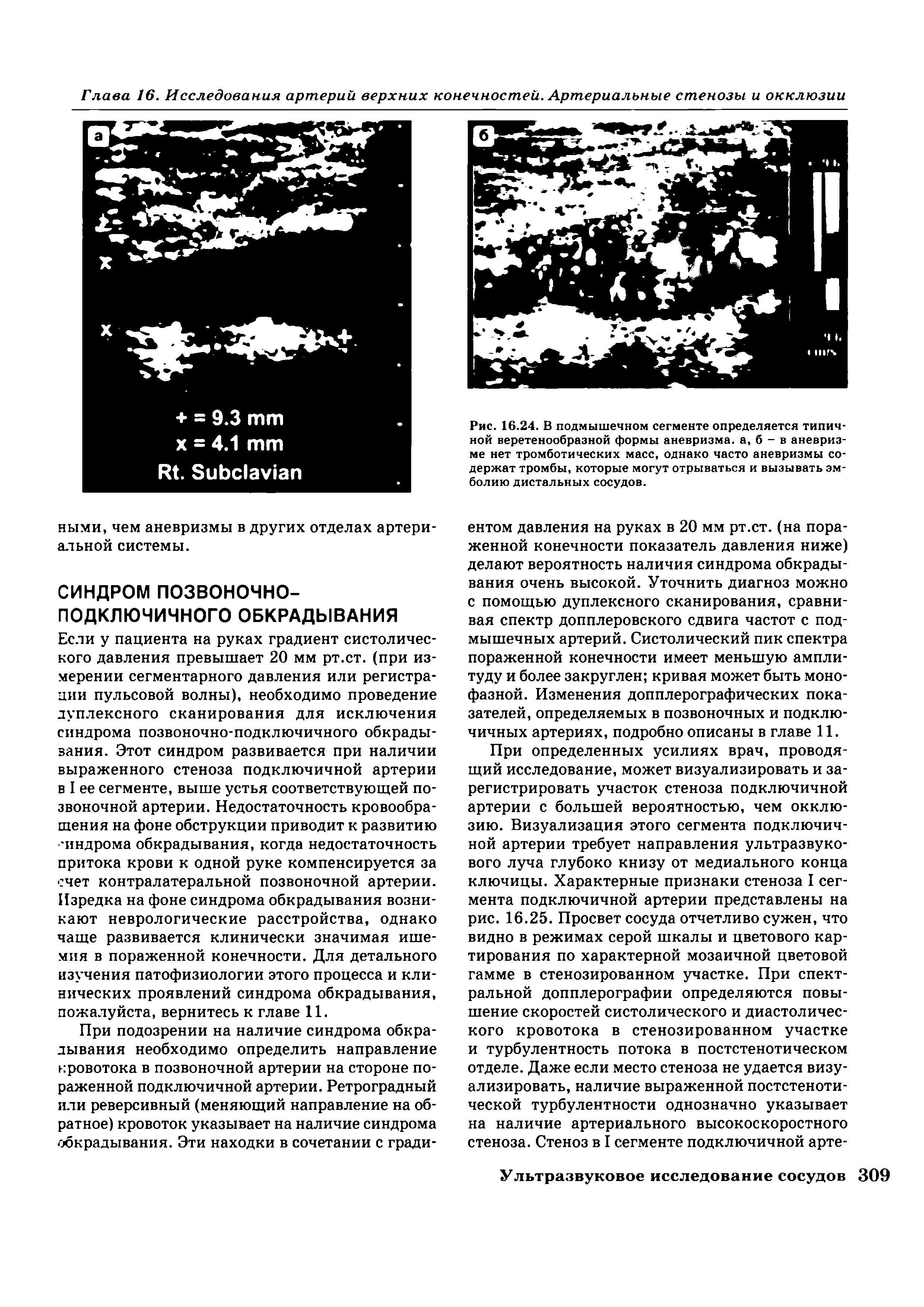 Рис. 16.24. В подмышечном сегменте определяется типичной веретенообразной формы аневризма, а, б - в аневризме нет тромботических масс, однако часто аневризмы содержат тромбы, которые могут отрываться и вызывать эмболию дистальных сосудов.