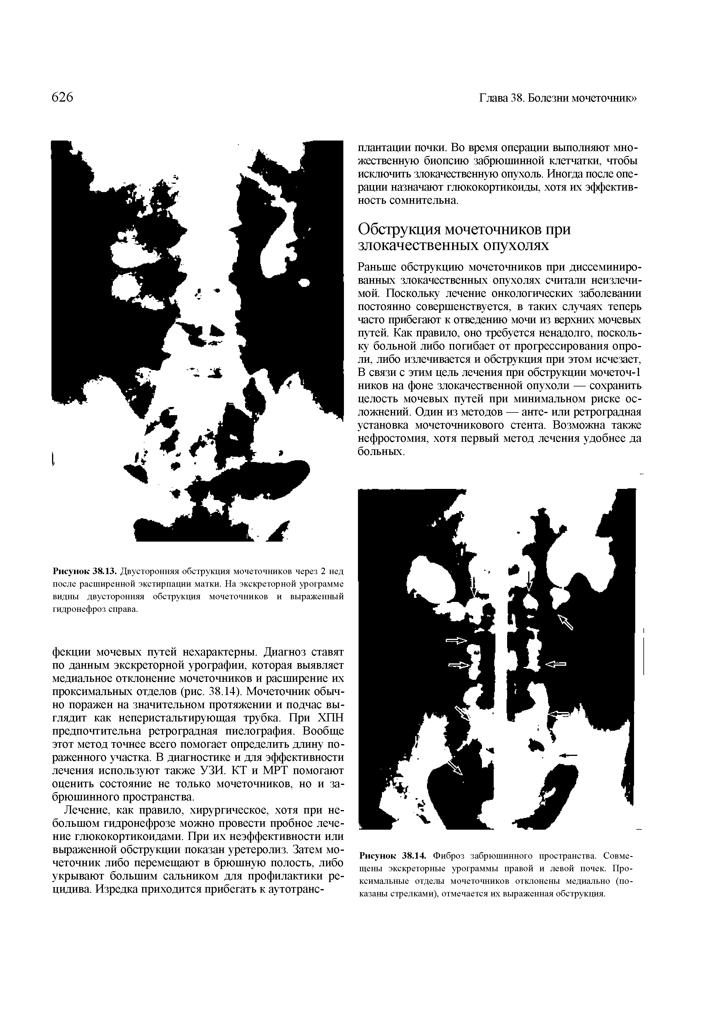 Рисунок 38.14. Фиброз забрюшинного пространства. Совмещены экскреторные урограммы правой и левой почек. Проксимальные отделы мочеточников отклонены медиально (показаны стрелками), отмечается их выраженная обструкция.