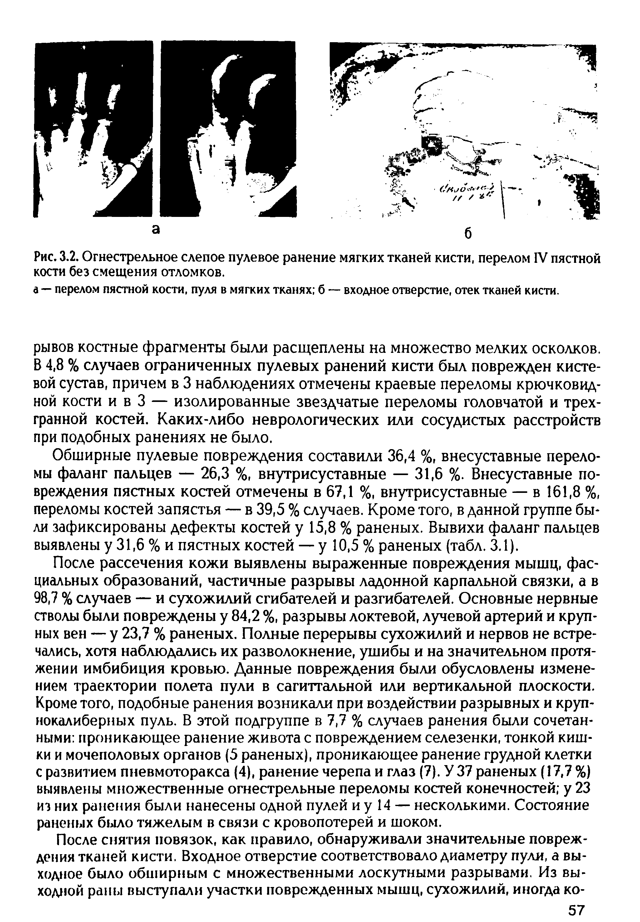 Рис. 3.2. Огнестрельное слепое пулевое ранение мягких тканей кисти, перелом IV пястной кости без смещения отломков.