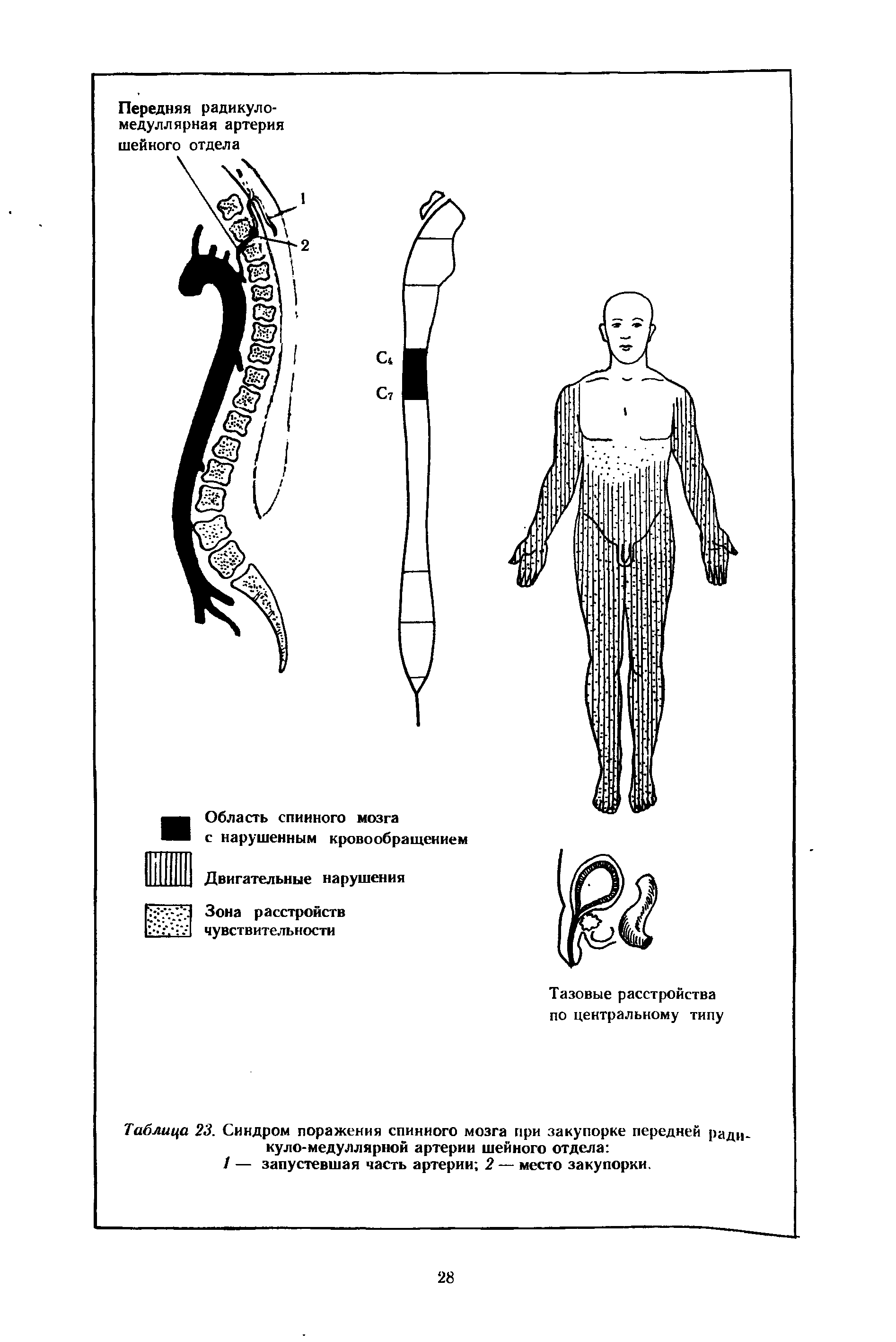 Таблица 23. Синдром поражения спинного мозга при закупорке передней ради куло-медуллярной артерии шейного отдела ...