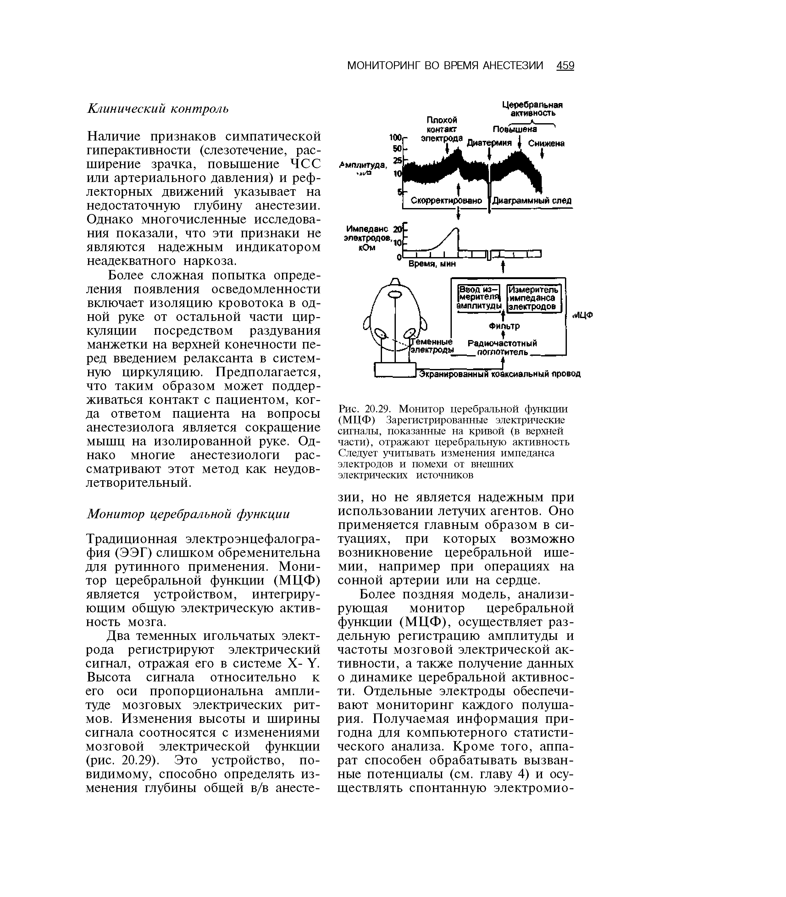 Рис. 20.29. Монитор церебральной функции (МЦФ) Зарегистрированные электрические сигналы, показанные на кривой (в верхней части), отражают церебральную активность Следует учитывать изменения импеданса электродов и помехи от внешних электрических источников...