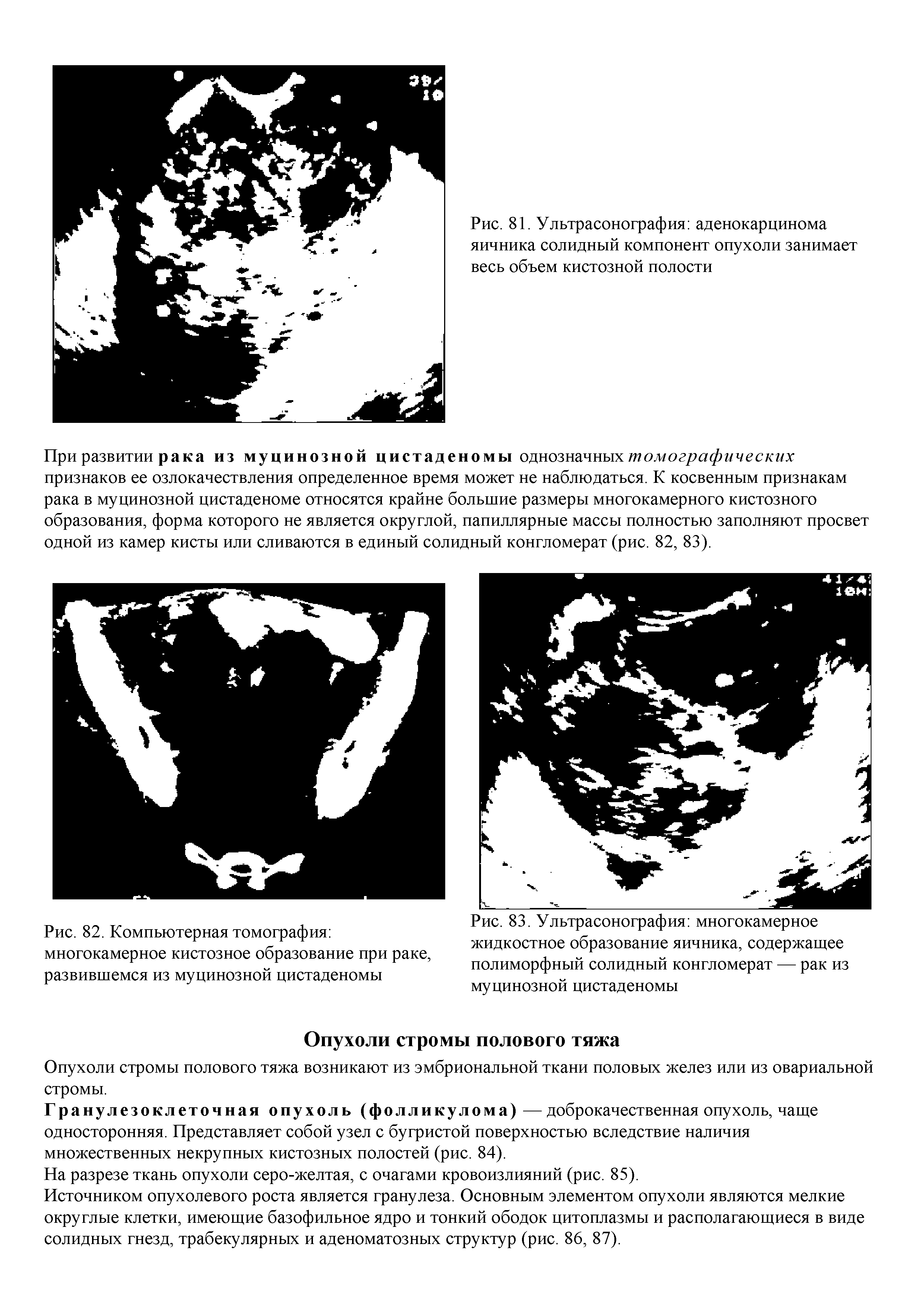 Рис. 83. Ультрасонография многокамерное жидкостное образование яичника, содержащее полиморфный солидный конгломерат — рак из муцинозной цистаденомы...