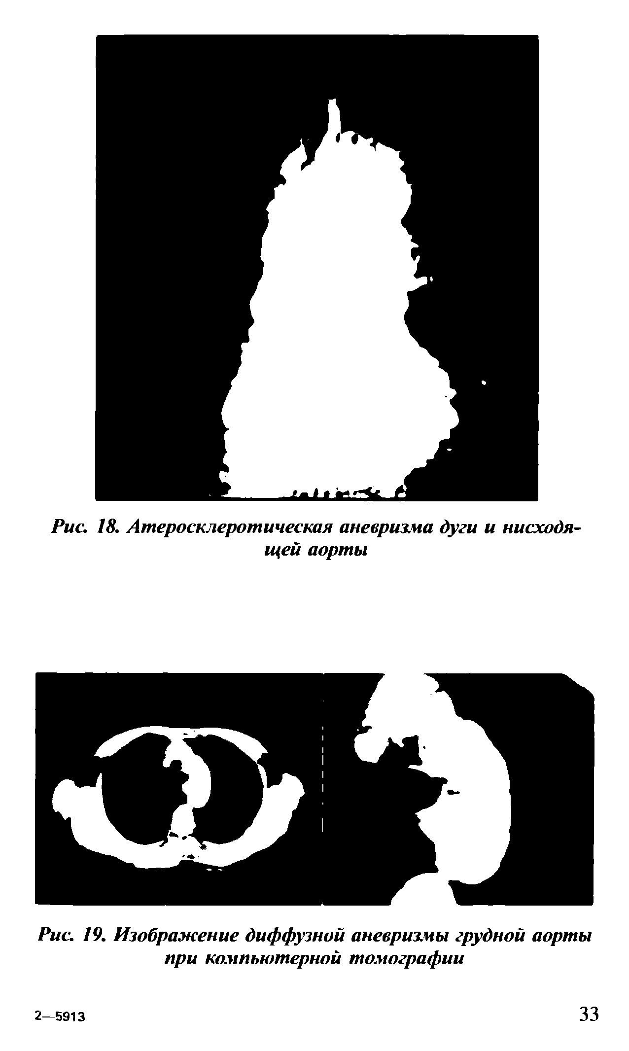 Рис. 19. Изображение диффузной аневризмы грудной аорты при компьютерной томографии...