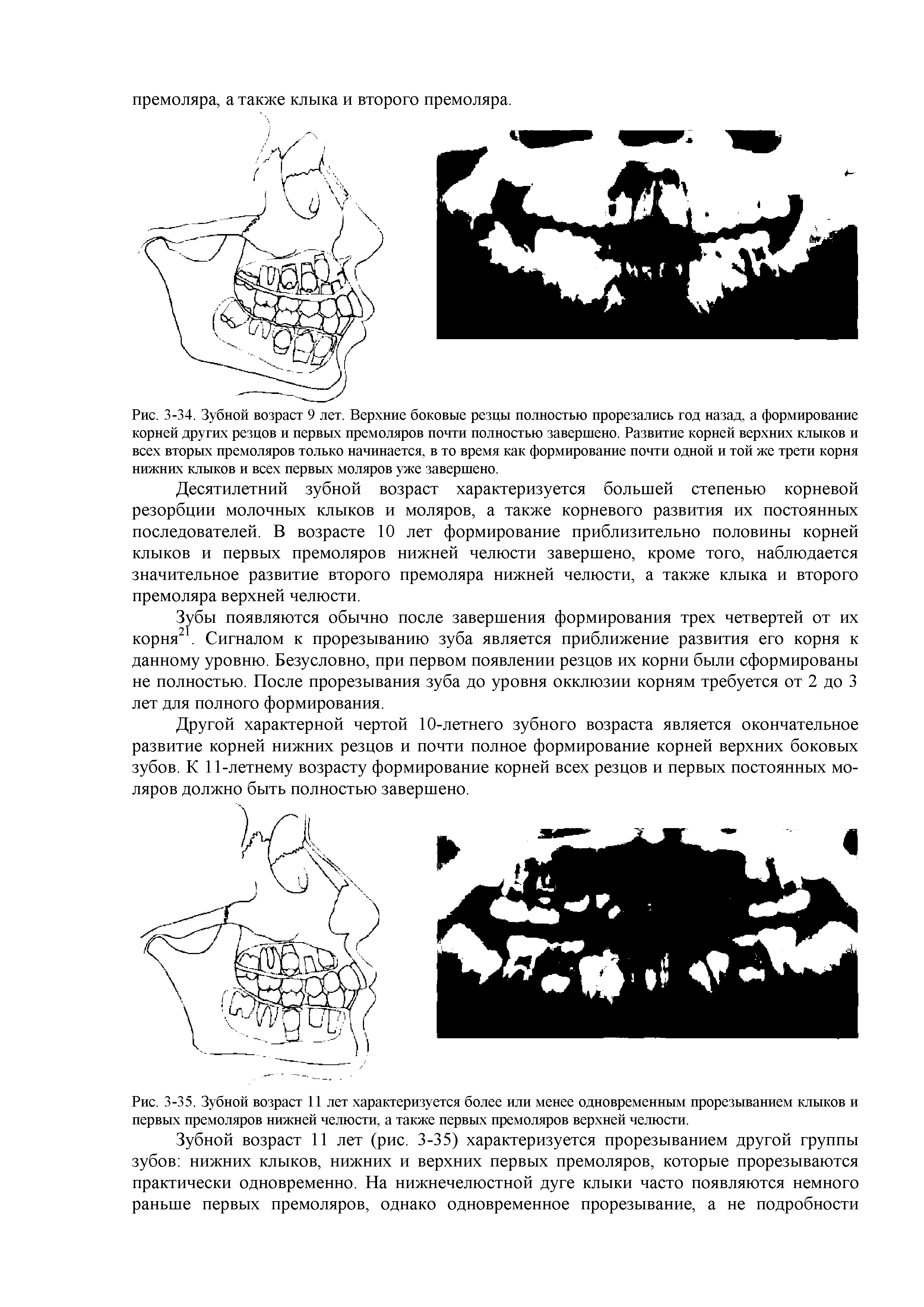 Рис. 3-35. Зубной возраст 11 лет характеризуется более или менее одновременным прорезыванием клыков и первых премоляров нижней челюсти, а также первых премоляров верхней челюсти.