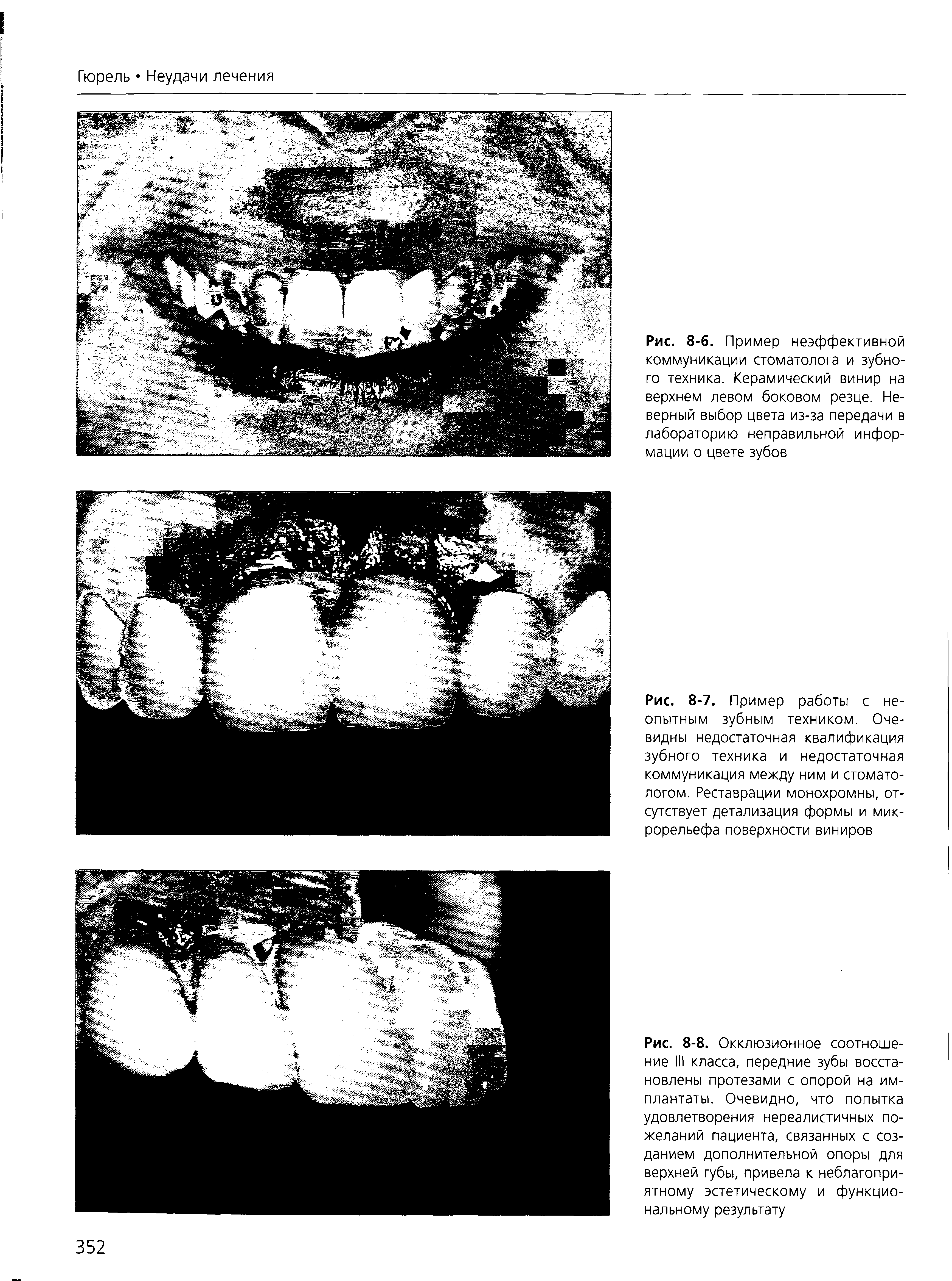 Рис. 8-6. Пример неэффективной коммуникации стоматолога и зубного техника. Керамический винир на верхнем левом боковом резце. Неверный выбор цвета из-за передачи в лабораторию неправильной информации о цвете зубов...