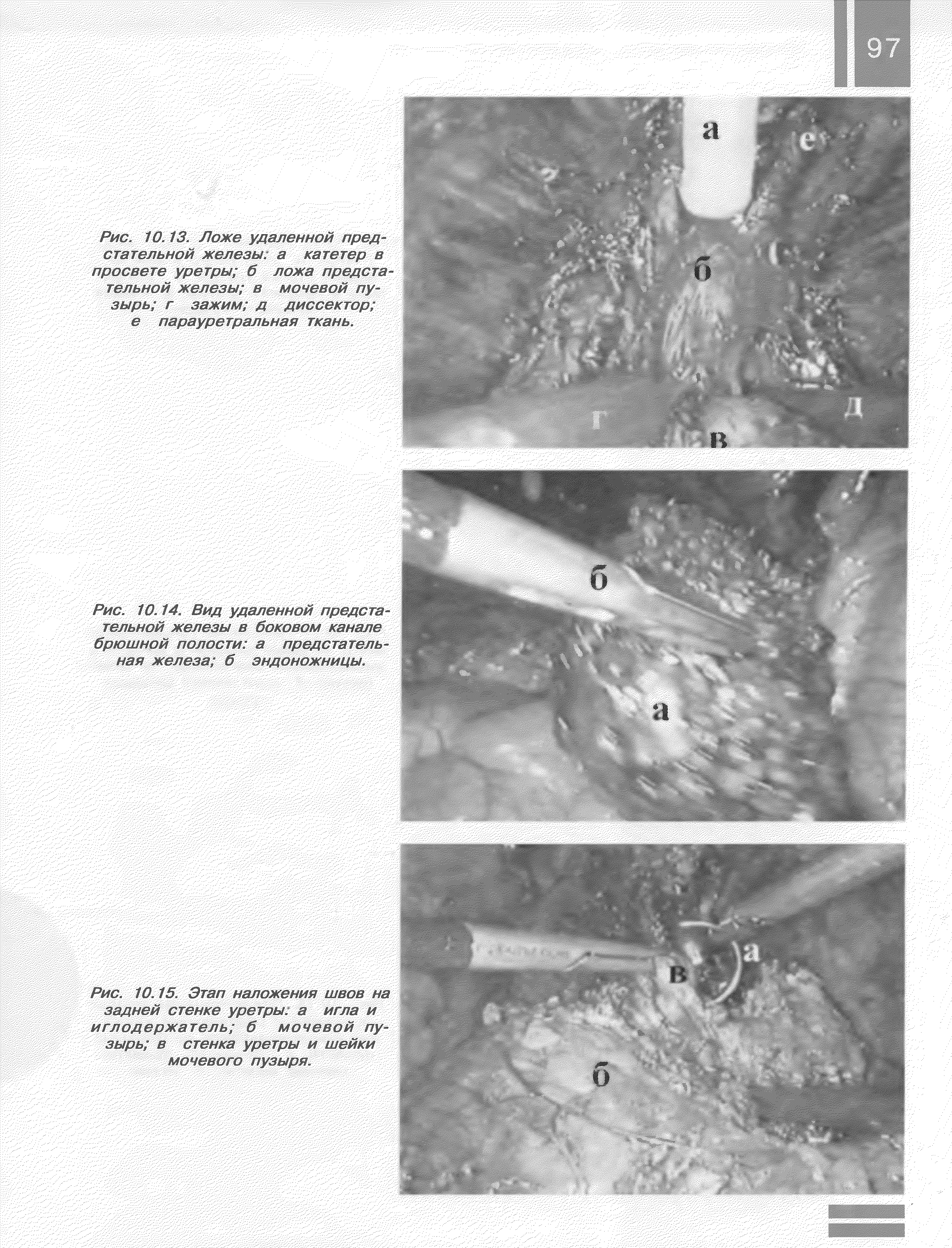 Рис. 10.14, Вид удаленной предста тельной железы б боковом канале брюшной полости а предстательная железа б эндоножницы.