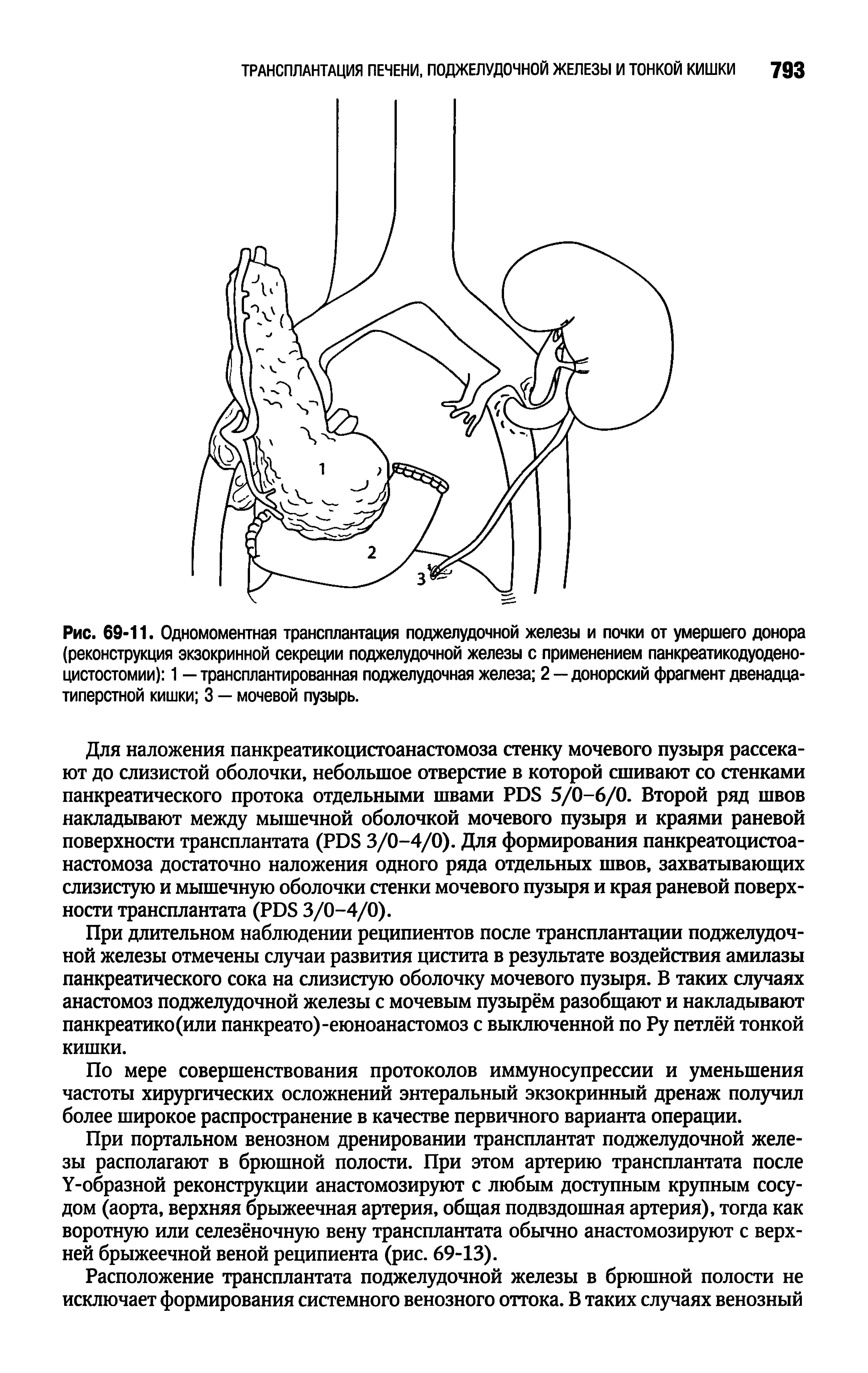 Рис. 69-11. Одномоментная трансплантация поджелудочной железы и почки от умершего донора (реконструкция экзокринной секреции поджелудочной железы с применением панкреатикодуодено-цистостомии) 1 — трансплантированная поджелудочная железа 2—донорский фрагмент двенадцатиперстной кишки 3 — мочевой пузырь.