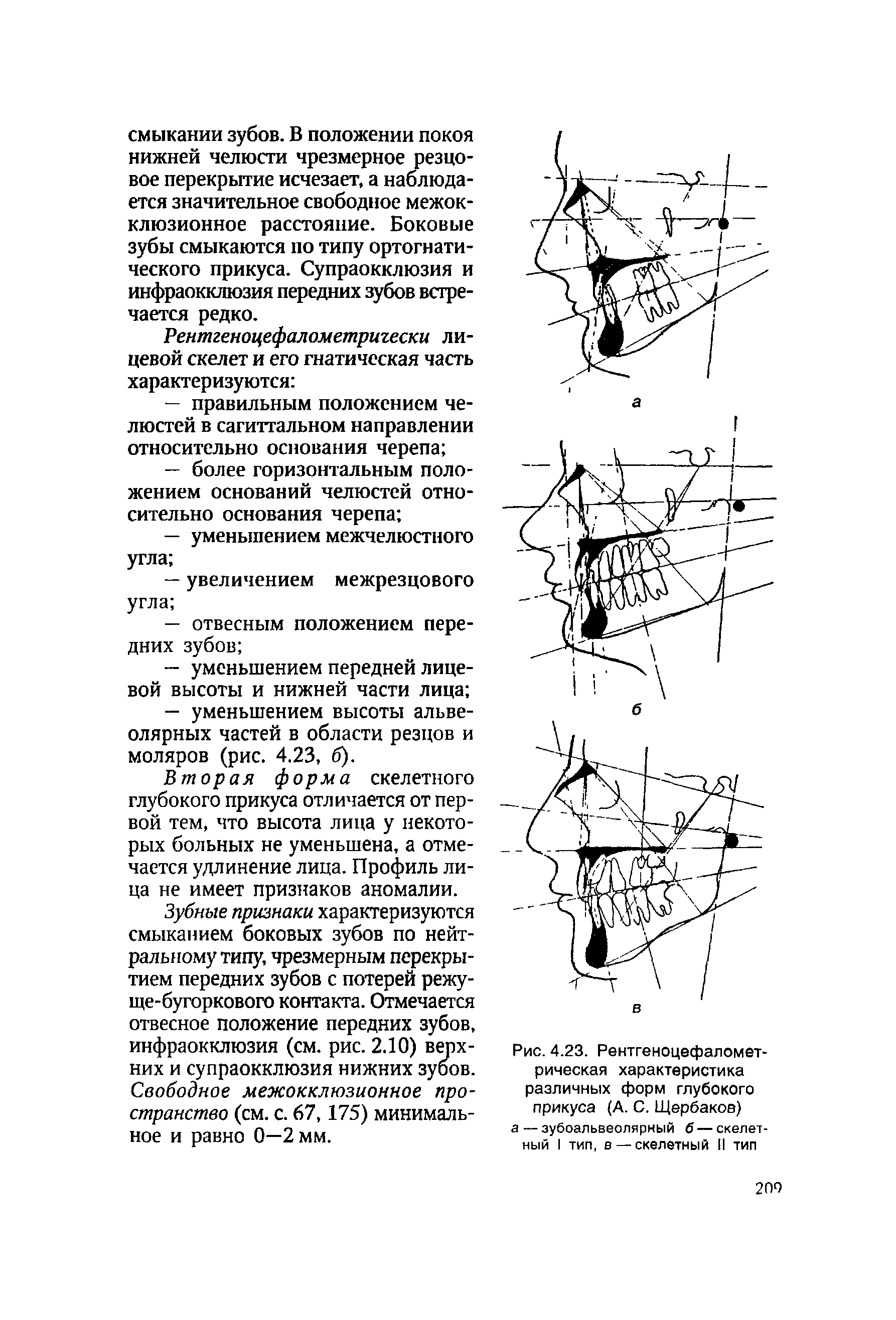 Рис. 4.23. Рентгеноцефалометрическая характеристика различных форм глубокого прикуса (А. С. Щербаков) а — зубоальвеолярный б — скелетный I тип, в — скелетный II тип...