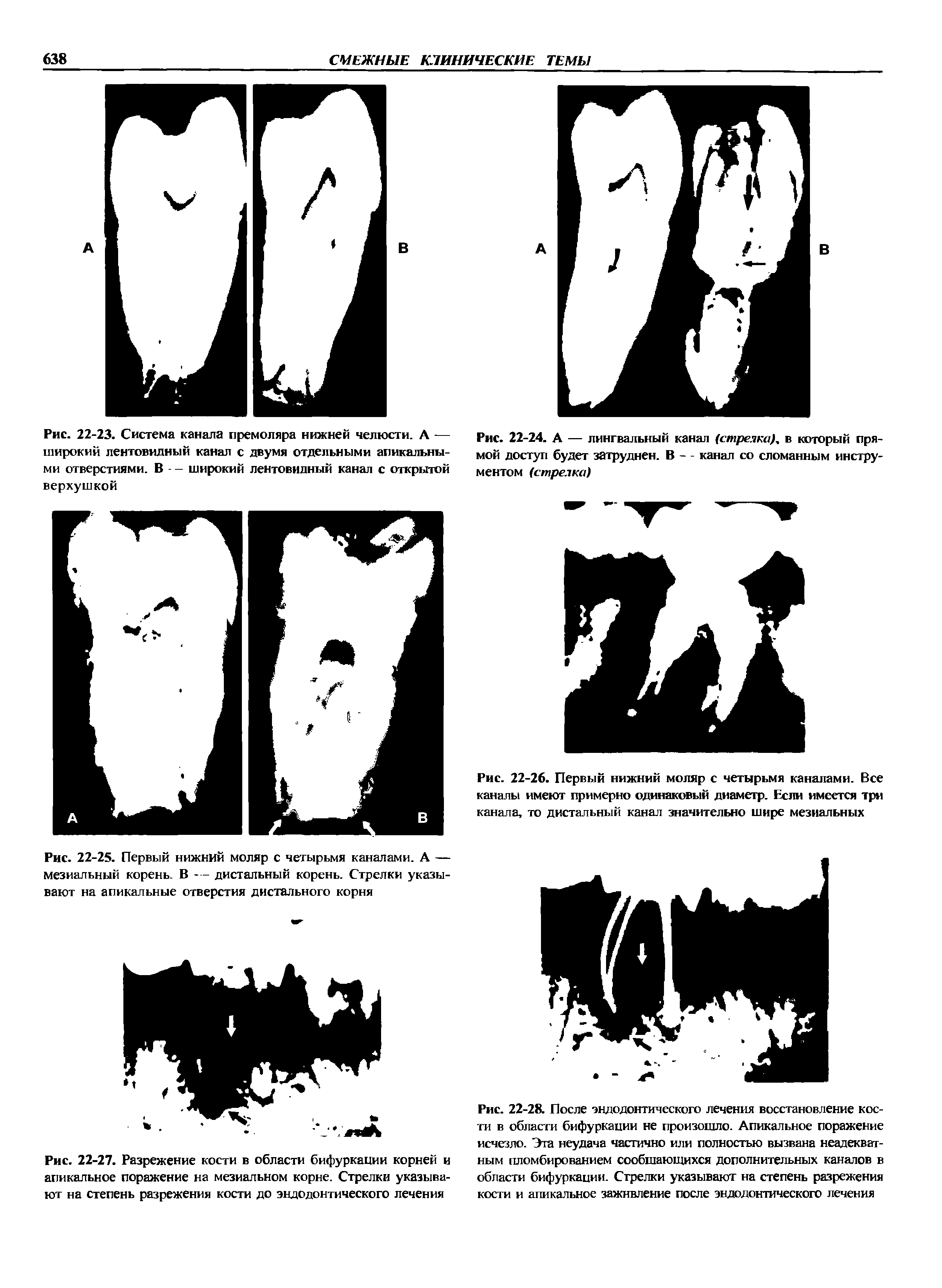 Рис. 22-25. Первый нижний моляр с четырьмя каналами. А — мезиальный корень. В - — дистальный корень. Стрелки указывают на апикальные отверстия дистального корня...