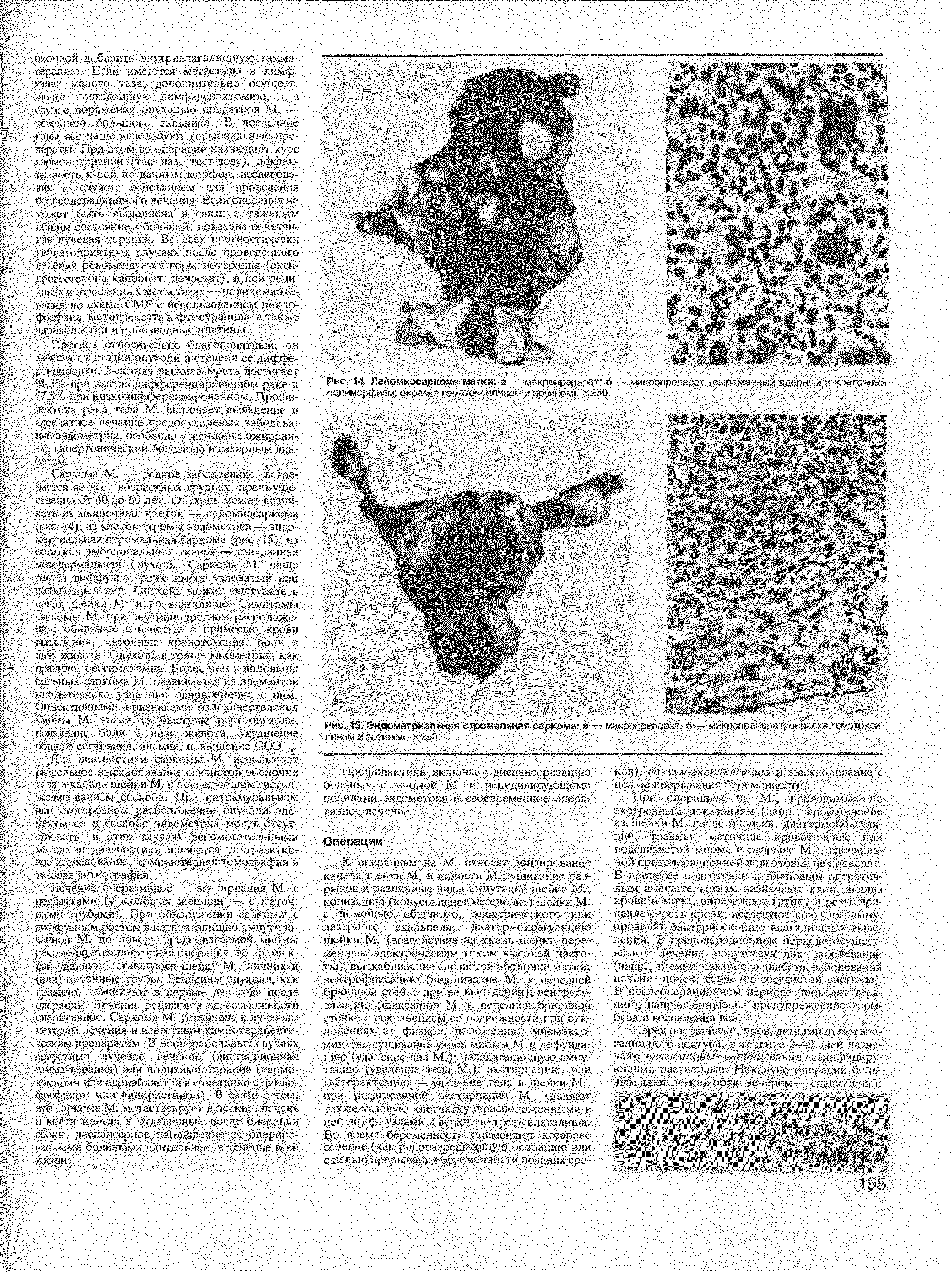 Рис. 15. Эндометриальная стромальная саркома а — макропрепарат, б — микропрепарат окраска гвматокси- . ЯЯШЯШЯШЯЯЯЯШЯгШЯЯЯЯШШЯЯшЯЯШШч...