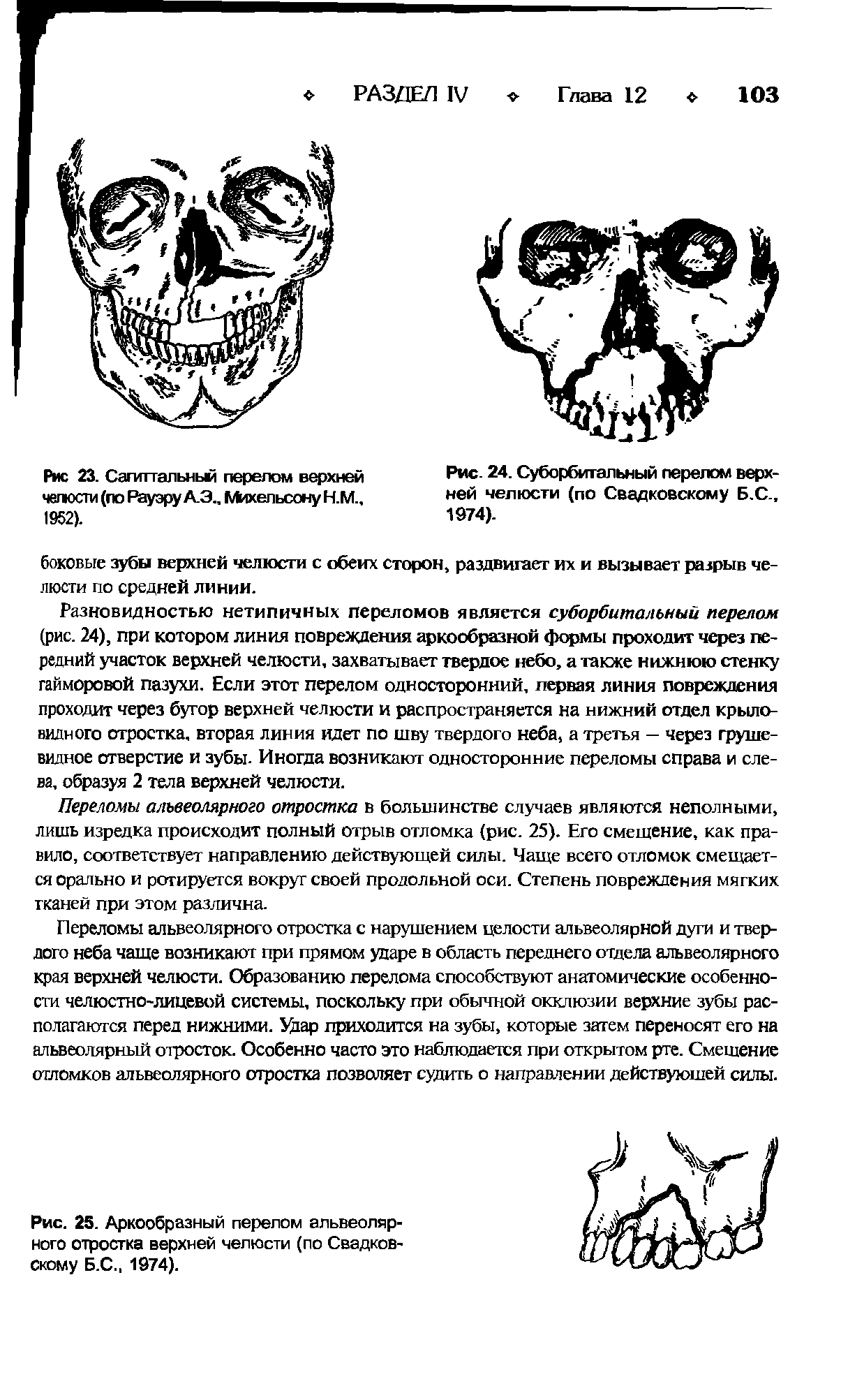 Рис. 25. Аркообразный перелом альвеолярного отростка верхней челюсти (по Свадковскому Б.С., 1974).