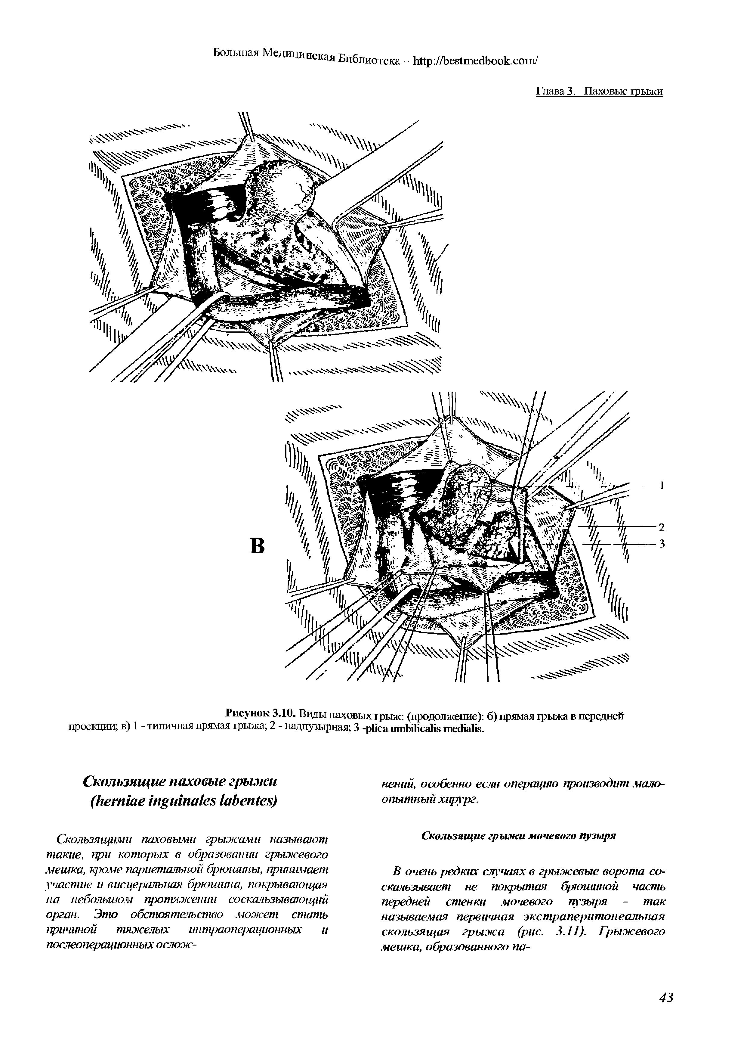 Рисунок 3.10. Виды паховых грыж (продолжение) б) прямая грыжа в передней проекции в) 1 - типичная прямая грыжа, 2 - надпузырная 3 - .