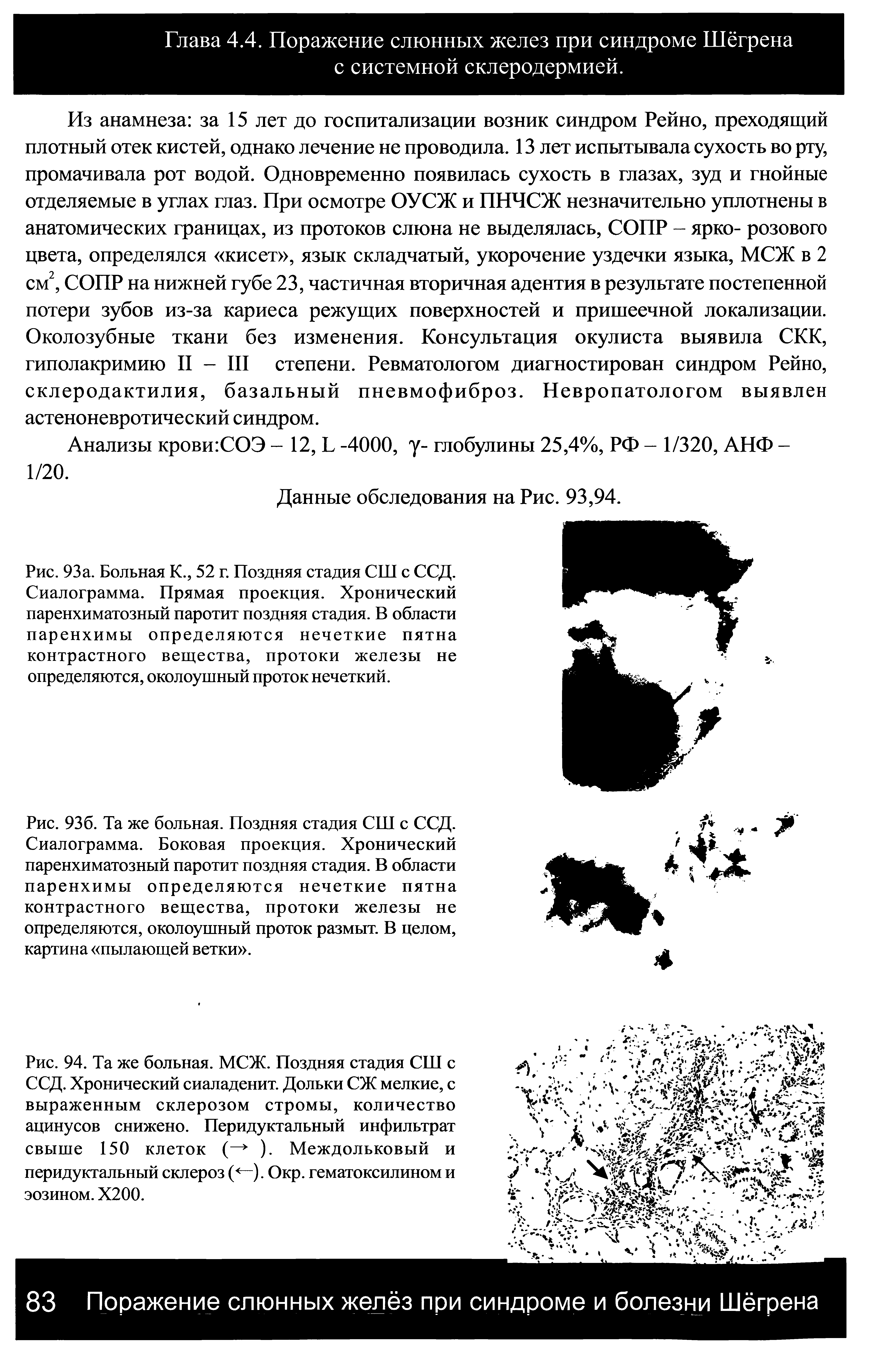 Рис. 93а. Больная К., 52 г. Поздняя стадия СШ с ССД. Сиалограмма. Прямая проекция. Хронический паренхиматозный паротит поздняя стадия. В области паренхимы определяются нечеткие пятна контрастного вещества, протоки железы не определяются, околоушный проток нечеткий.