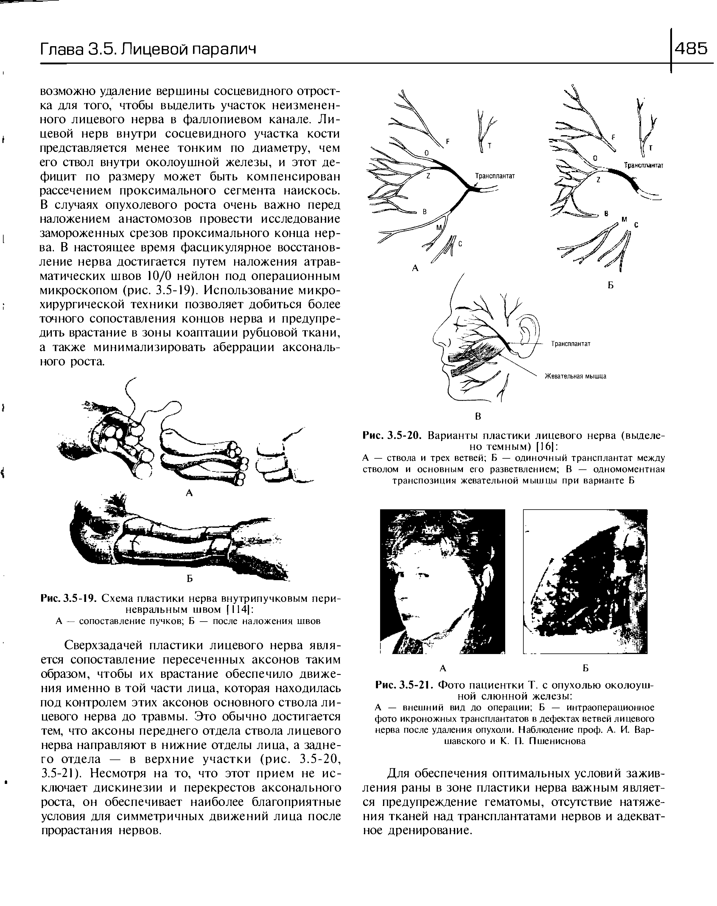 Рис. 3.5-20. Варианты пластики лицевого нерва (выделено темным) [16 ...