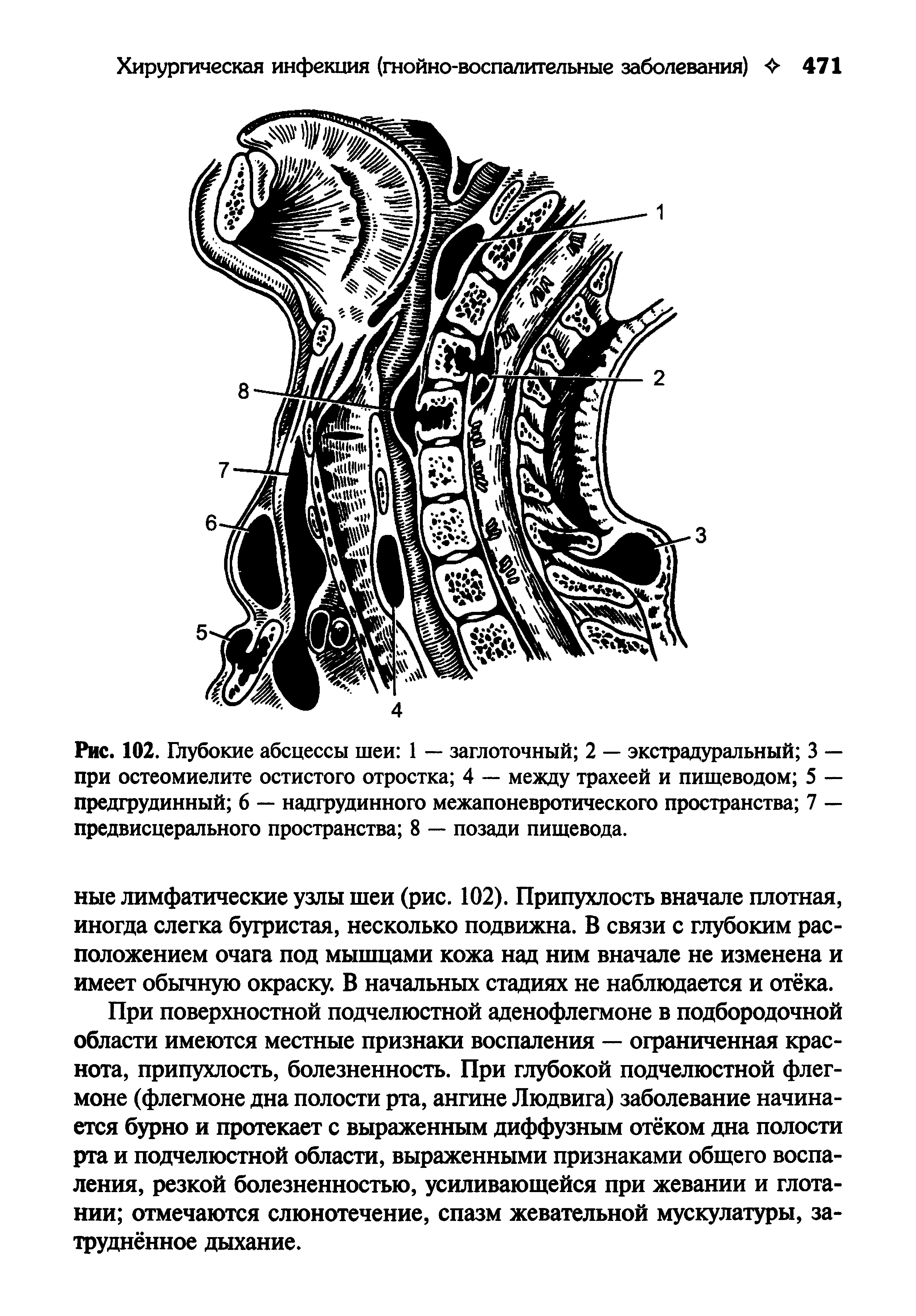 Рис. 102. Глубокие абсцессы шеи 1 — заглоточный 2 — экстрадуральный 3 — при остеомиелите остистого отростка 4 — между трахеей и пищеводом 5 — предгрудинный 6 — надгрудинного межапоневротического пространства 7 — предвисцерального пространства 8 — позади пищевода.