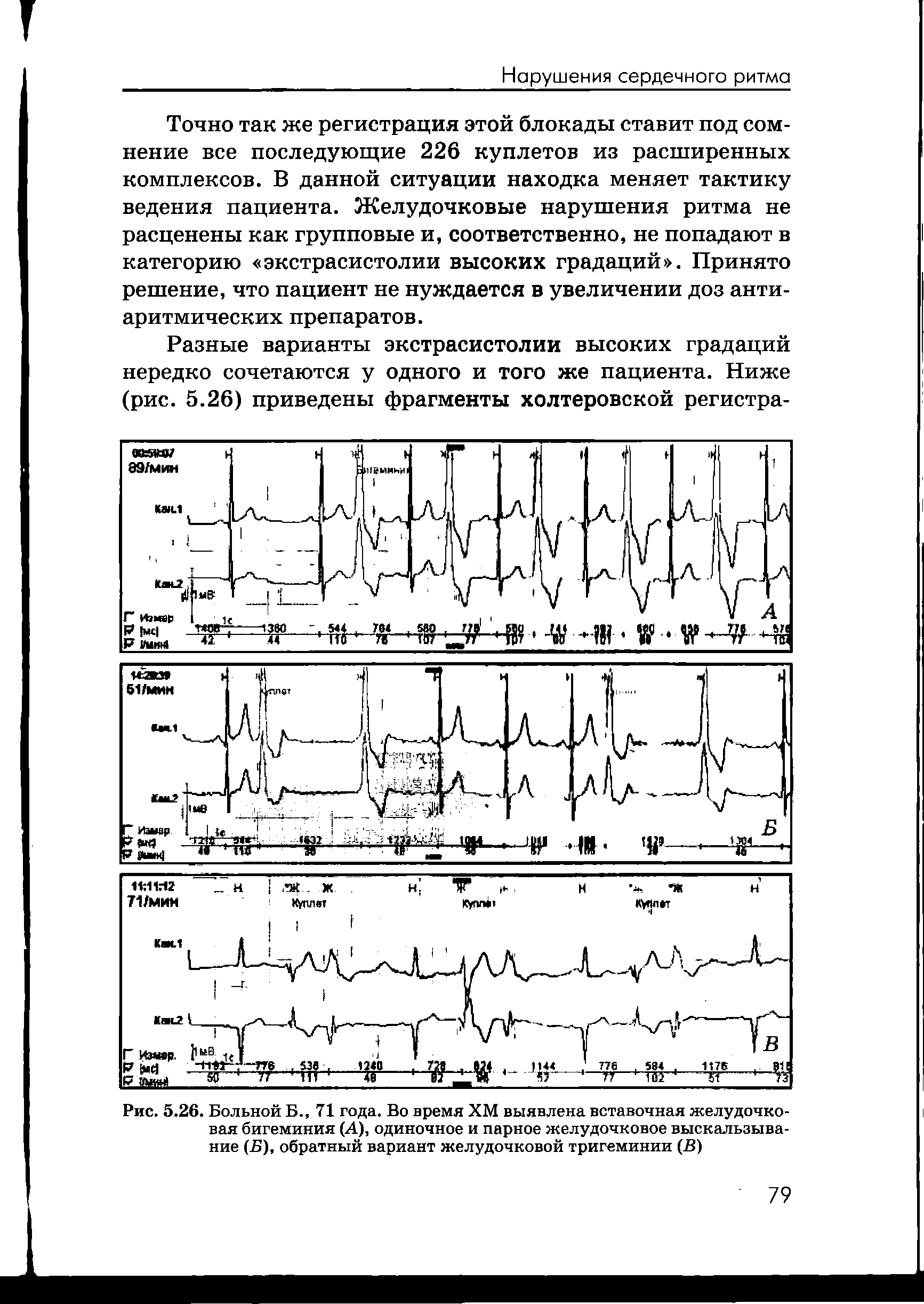 Рис. 5.26. Больной Б., 71 года. Во время ХМ выявлена вставочная желудочковая бигеминия (А), одиночное и парное желудочковое выскальзывание (Б), обратный вариант желудочковой тригеминии (В)...