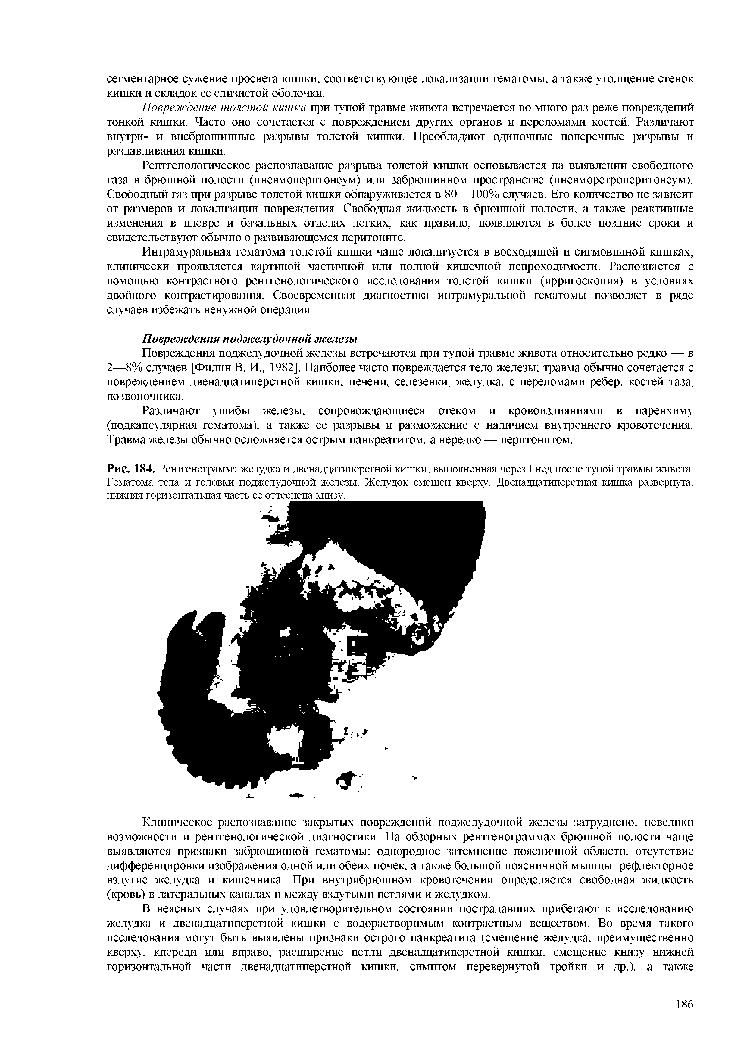 Рис. 184. Рентгенограмма желудка и двенадцатиперстной кишки, выполненная через I нед после тупой травмы живота. Гематома тела и головки поджелудочной железы. Желудок смещен кверху. Двенадцатиперстная кишка развернута, нижняя горизонтальная часть ее оттеснена книзу. ...