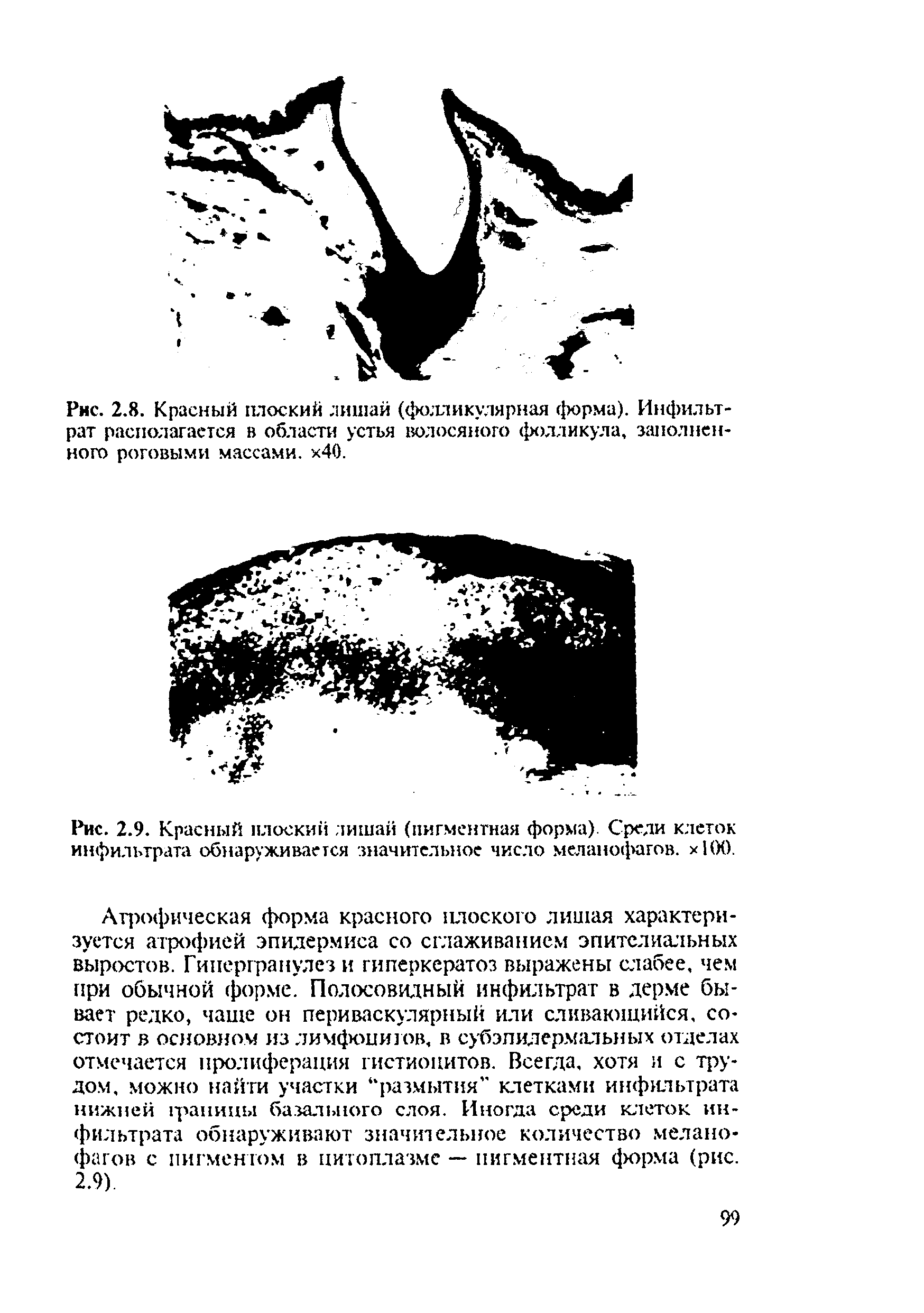 Рис. 2.9. Красный плоский лишай (пигментная форма). Среди клеток инфильтрата обнаруживается значительное число меланофагов. хНХ).